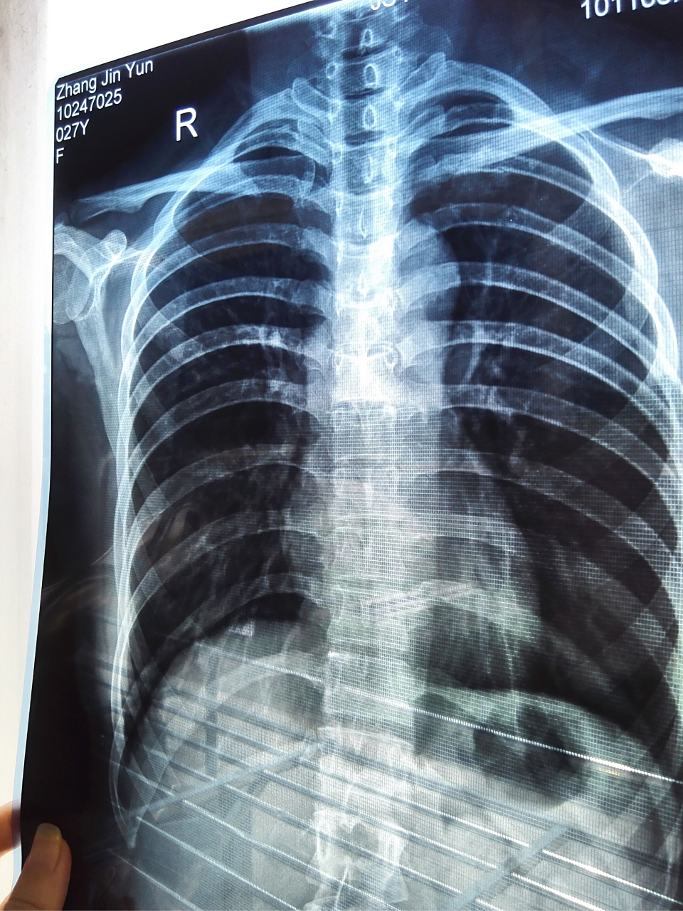 株洲男子暴力对待女友,致其骨折,网友:处罚太轻了,必须严惩!