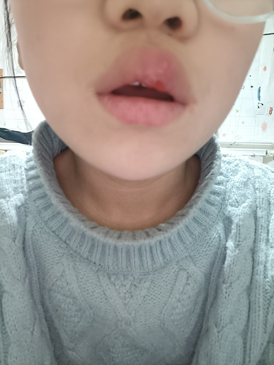 一觉醒来上嘴唇肿了怎么办?