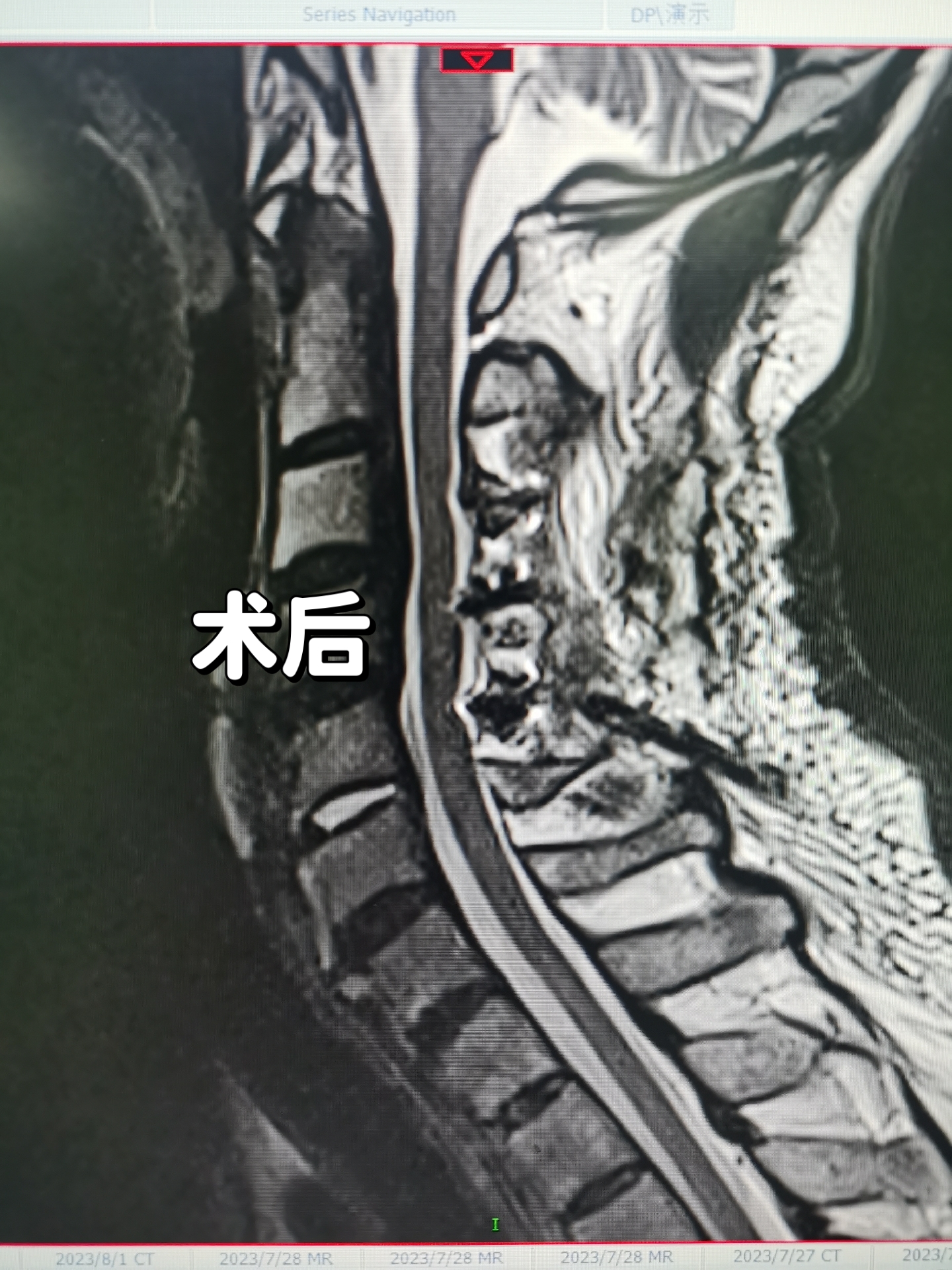 颈椎前凸消失图片