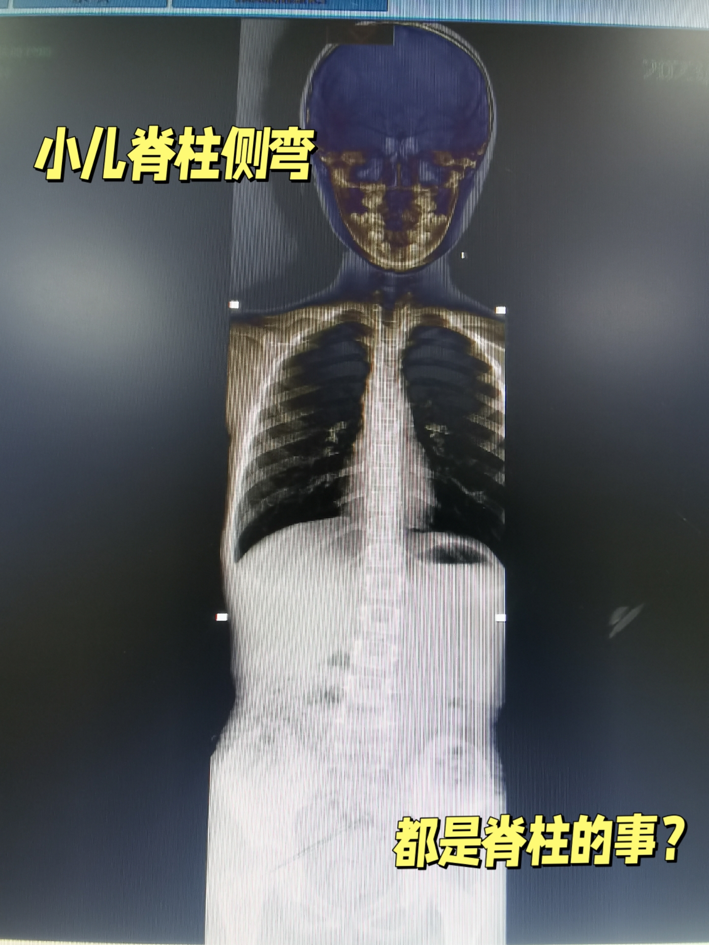 剃刀背不一定都是脊柱的事,也有可能是双下肢不等长造成的.