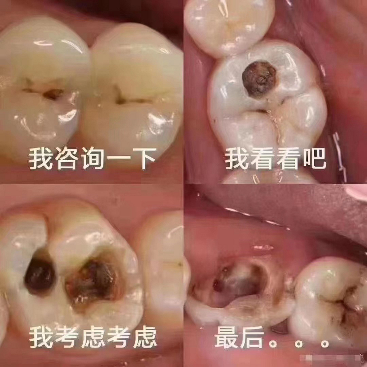 导致牙齿表面出现凹洞和裂缝,如果不及时治疗,可能会引起严重的并发症