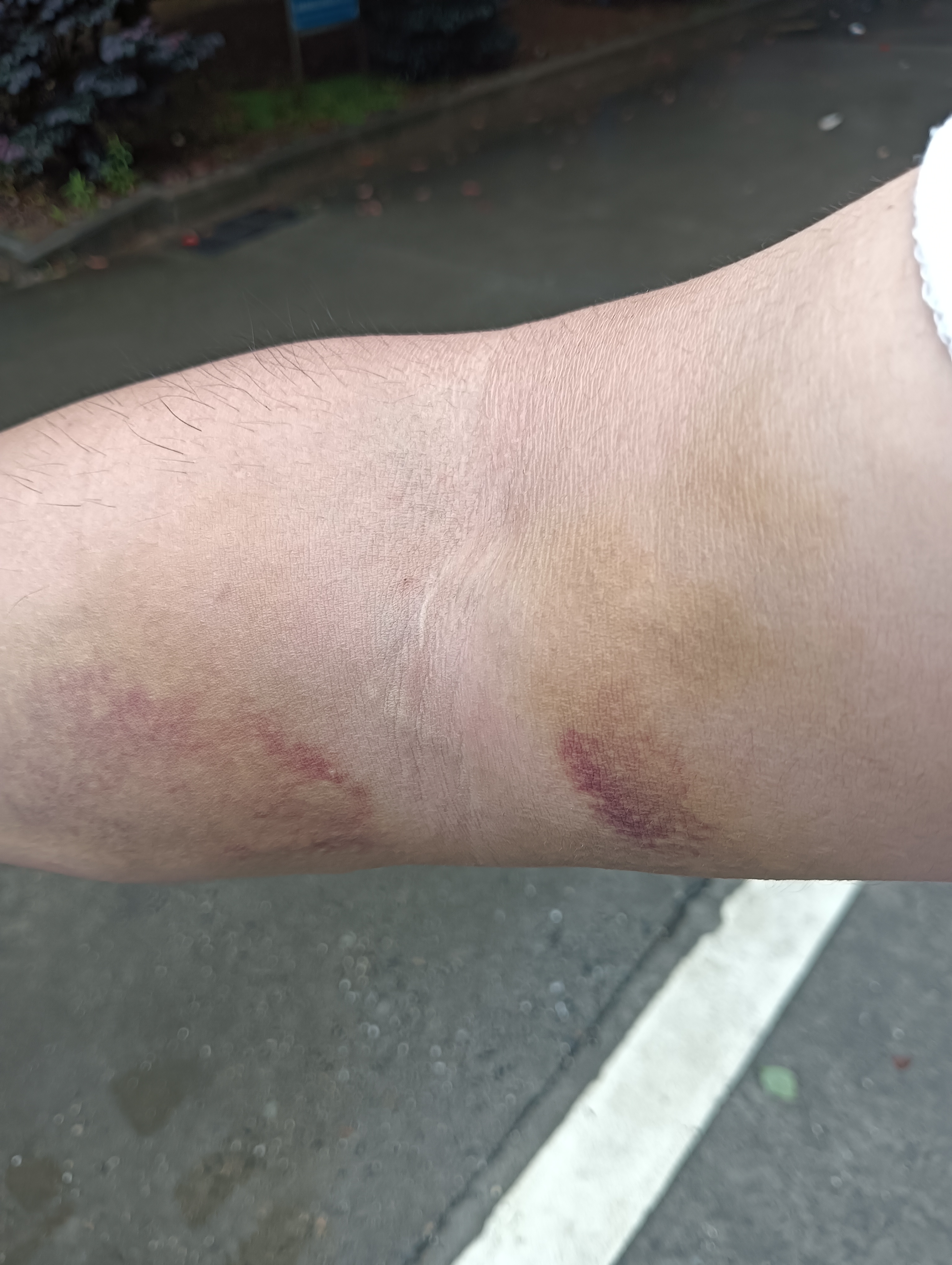 蓝思科技二楼体检中心太没良心了拿钱体检抽血抽成这