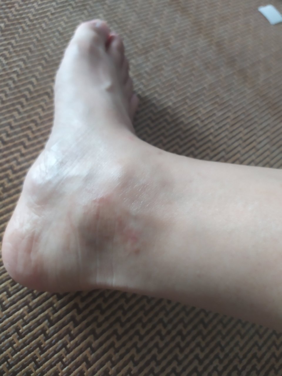 问一下这是,脚痒里面痒血管好像也肿了