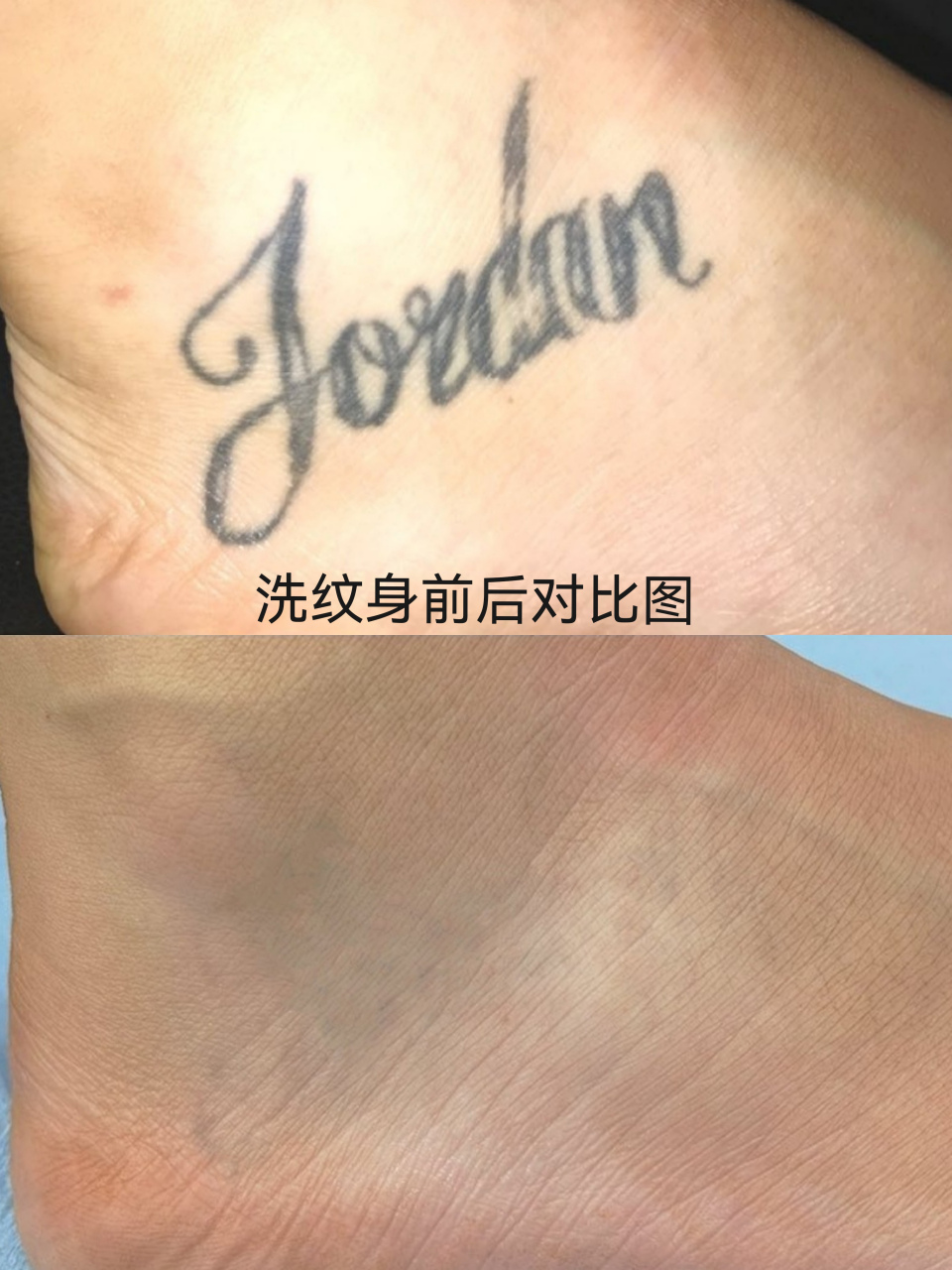 上卿洗纹身,脚背上的字母纹身清洗.