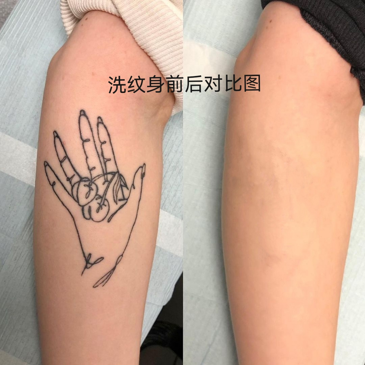 重庆上卿洗纹身shxiwenshen# 手臂线条纹身清洗效果前后对比,洗了几