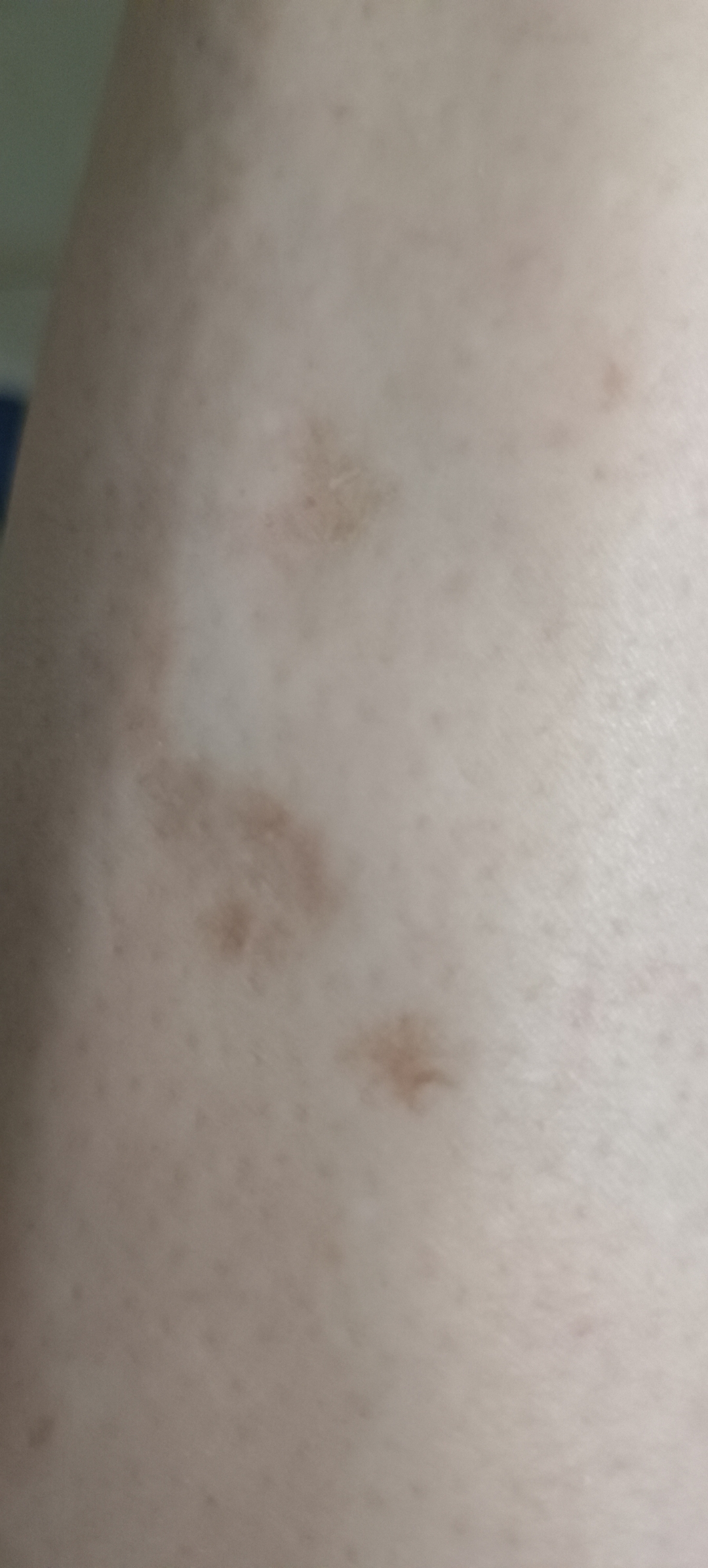 前两个月就是小腿发痒,用手一挠就都是小红点,是皮肤过敏吗?