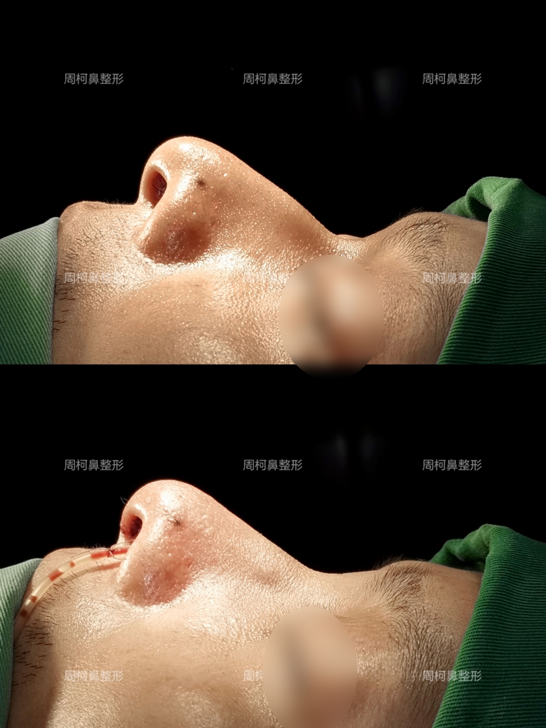 男生顾客,因受外伤后鼻梁歪斜突出,自觉形态不佳只想矫正歪鼻,故行