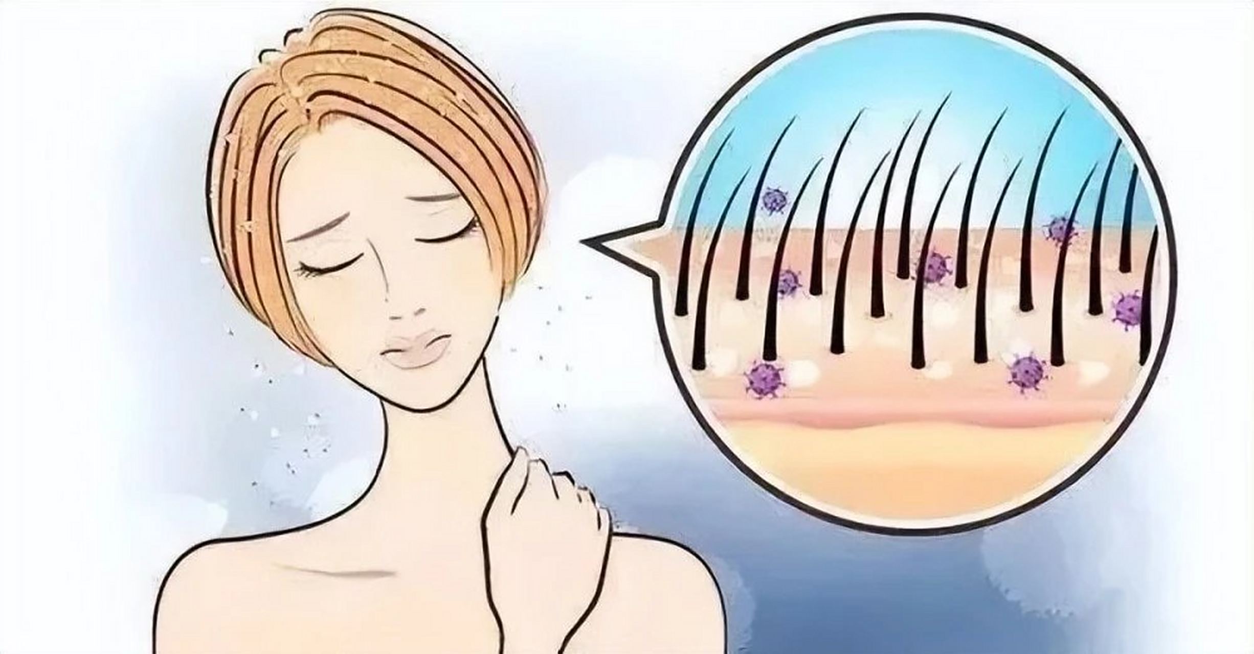 邯郸燕赵中医院皮肤科医生介绍毛囊炎种类: 颈部硬结性毛囊炎 又称