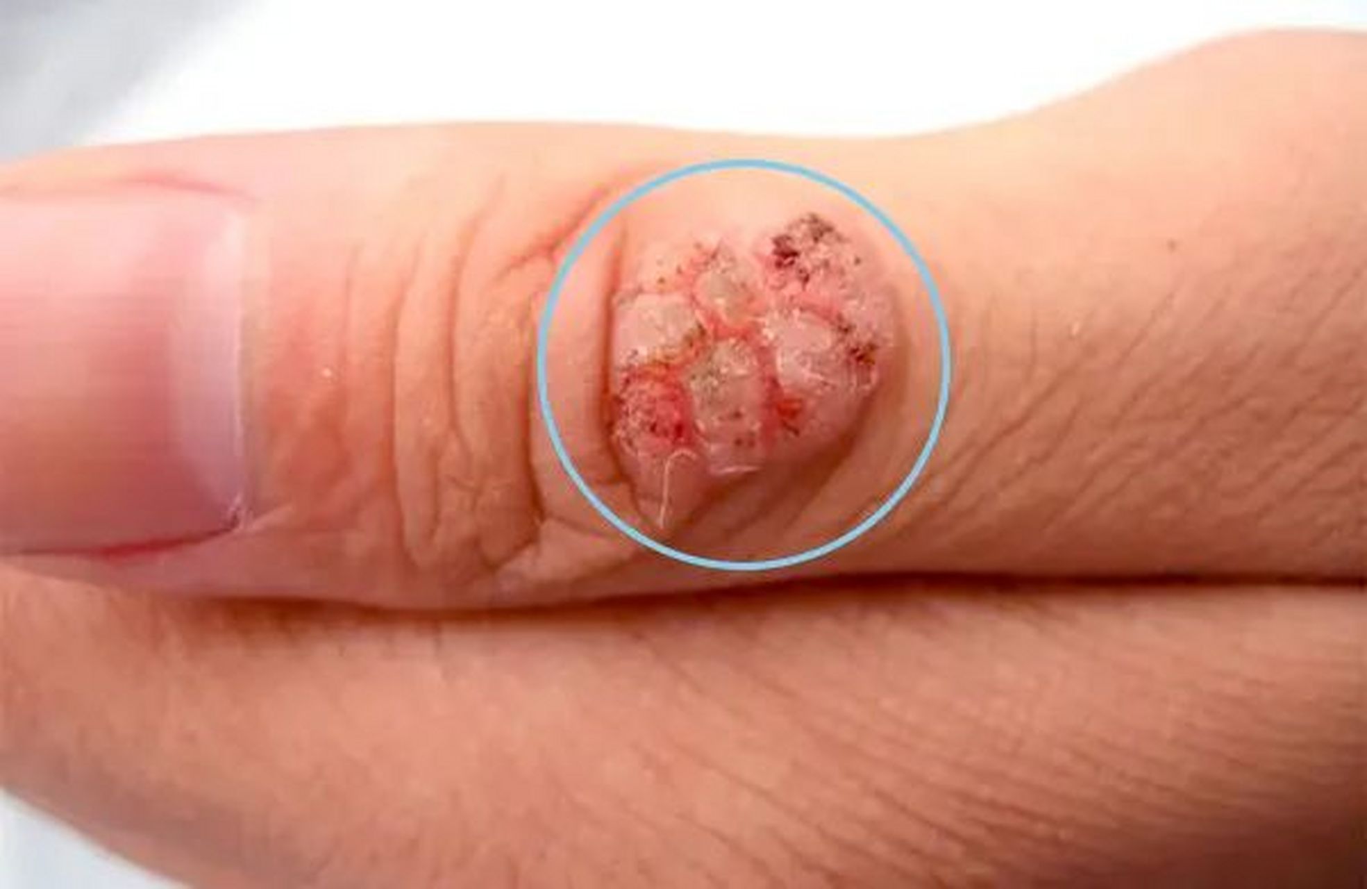 扁平疣 与3/10/2629/41型hpv感染有关.