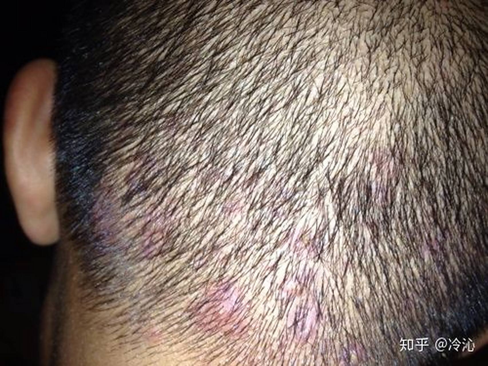 头上长红点,疙瘩,还会化脓,我也不知道是脂溢性皮炎还去细菌感染,总之