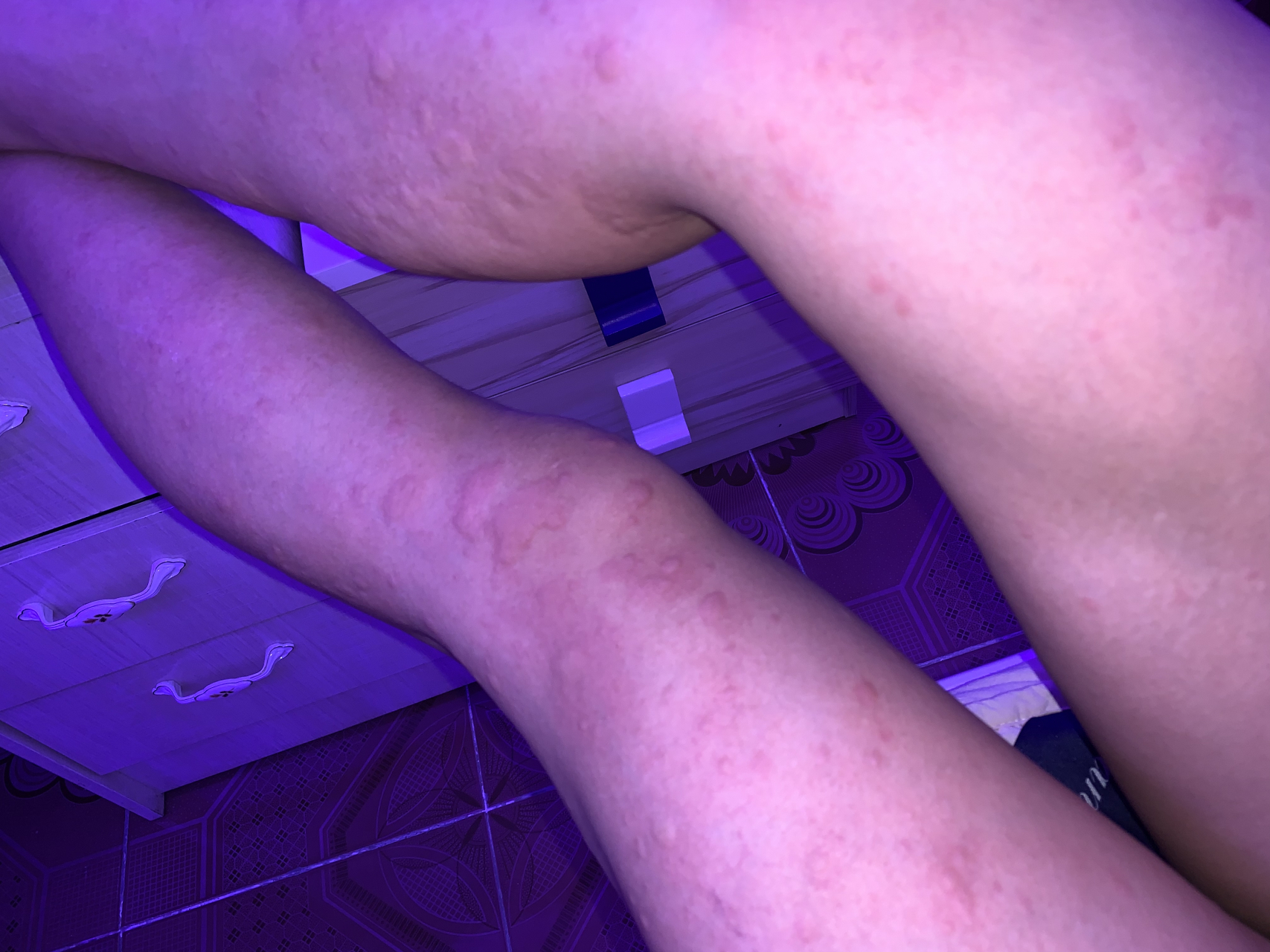 为什么到了晚上手脚身上就起红包?痒的难受!