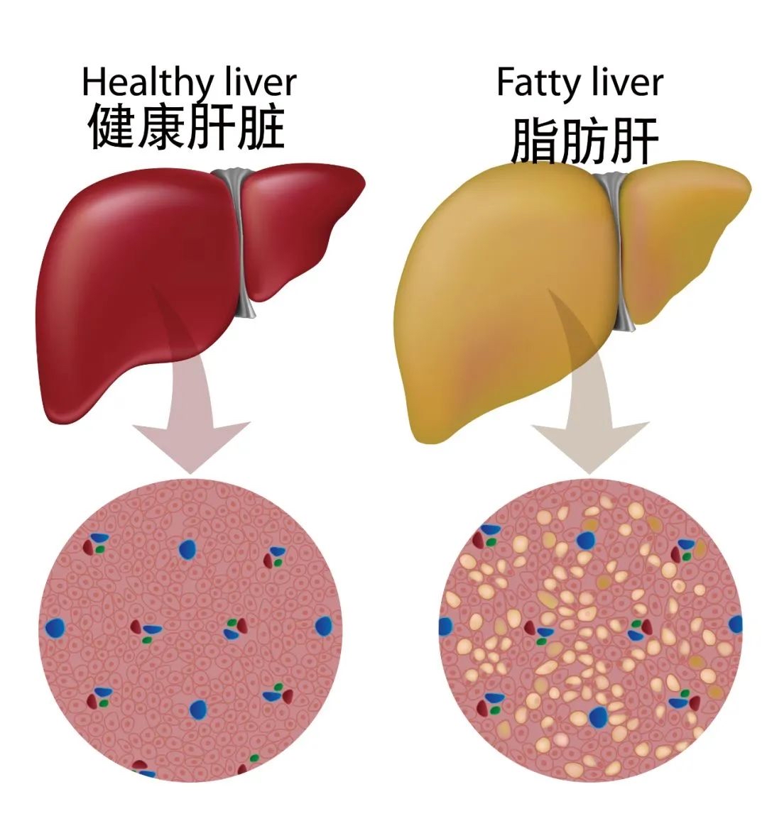 脂肪肝解剖图图片