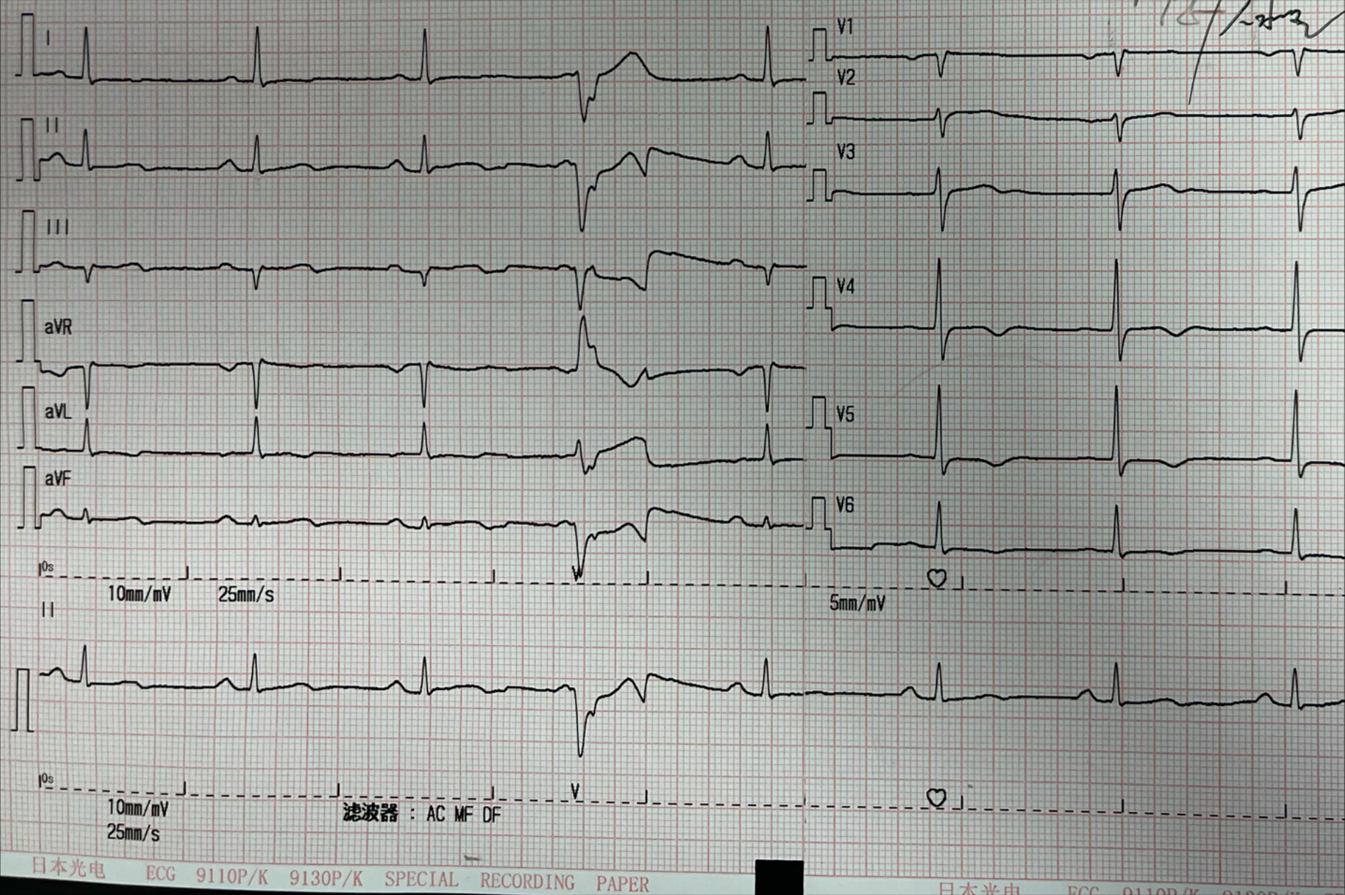 心梗心电图导联图片