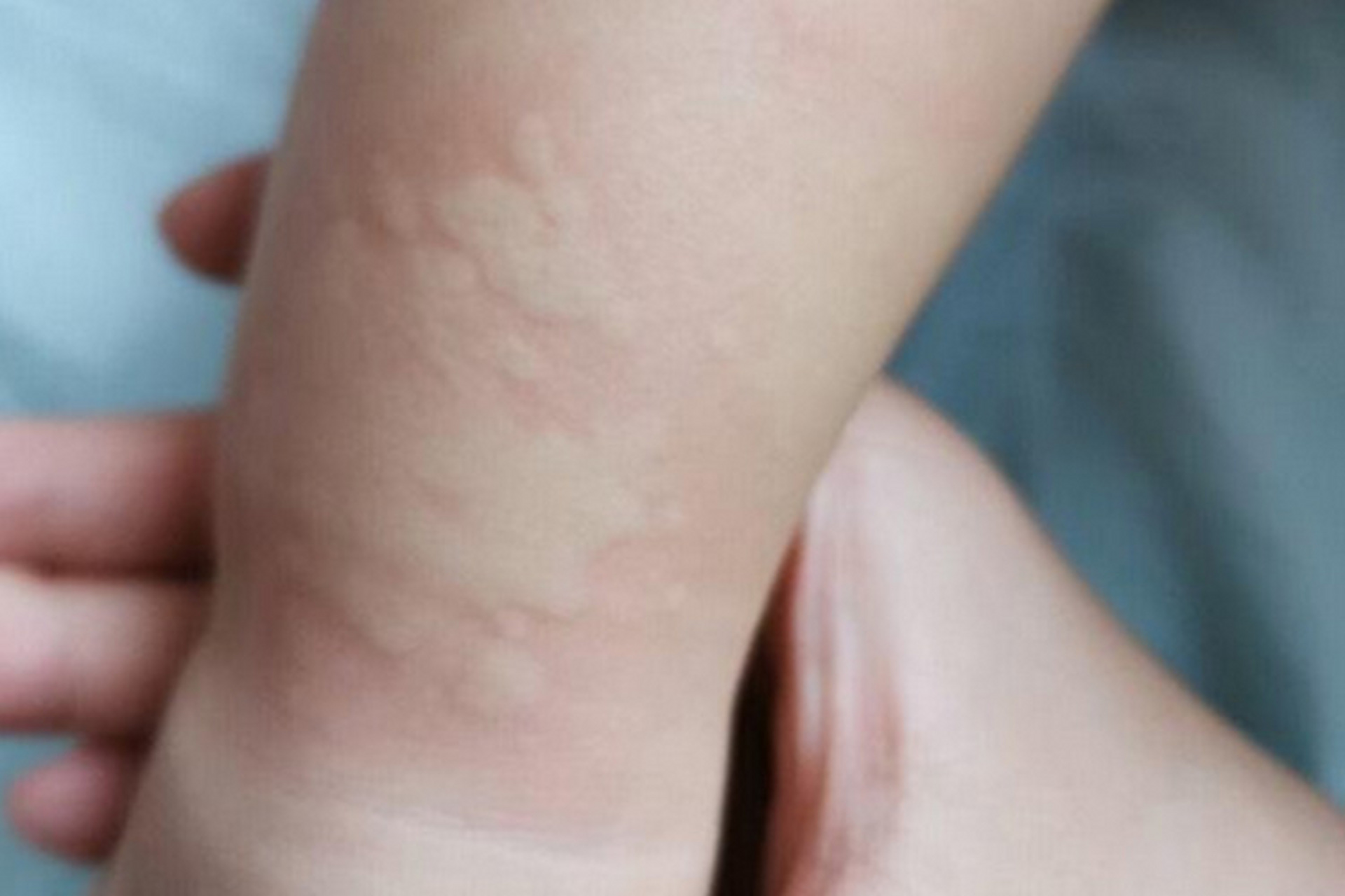 孩子身上突然长了一些风团,就像蚊子咬过一般    非常的痒, 知道这是