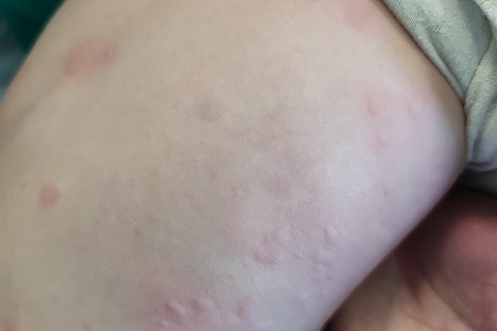 孩子身上突然长了一些风团,就像蚊子咬过一般    非常的痒, 知道这是