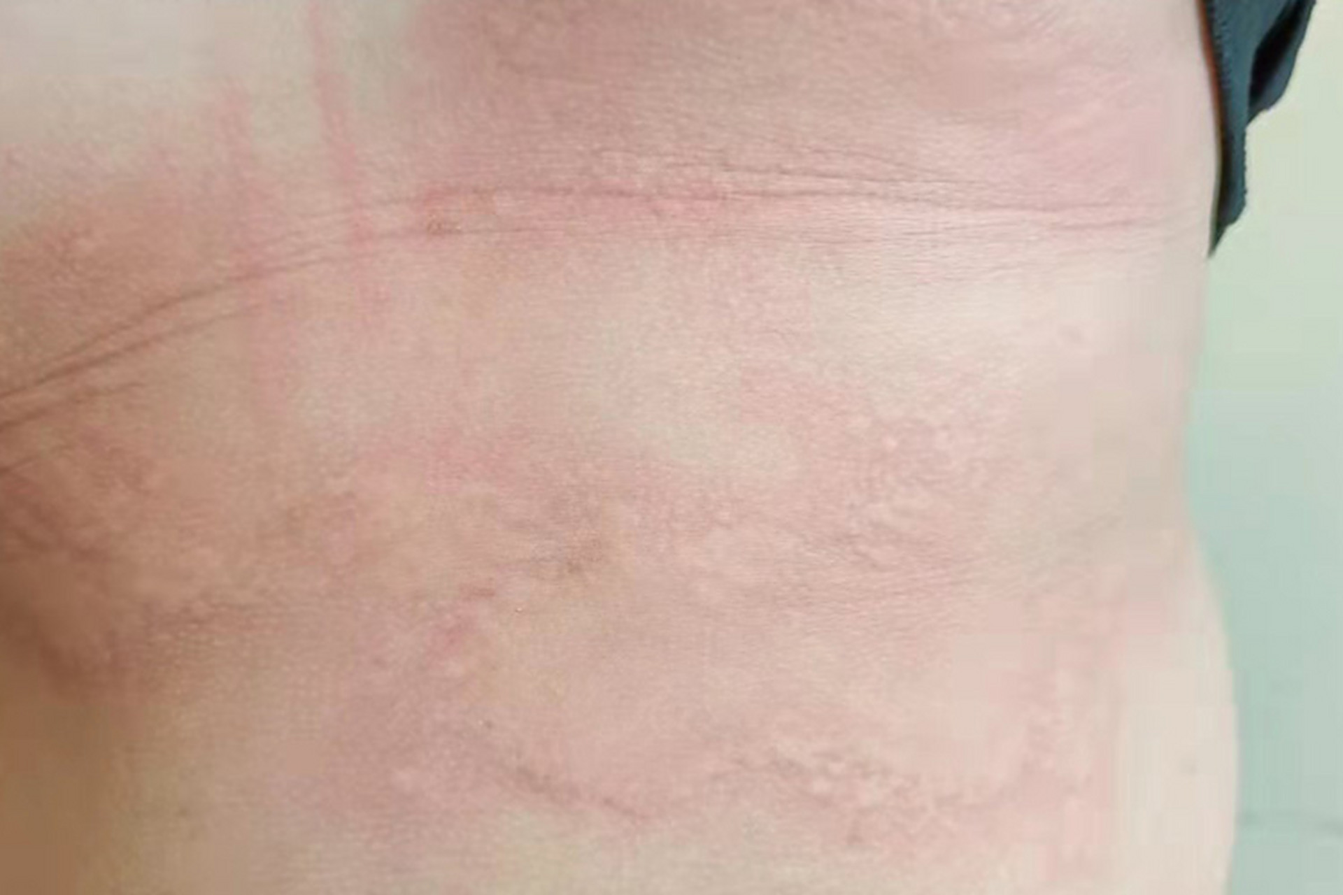 孩子身上突然长了一些风团,就像蚊子咬过一般    非常的痒, 知道这是