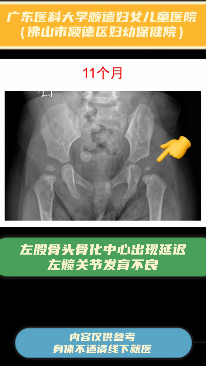 左股骨头骨化中心出现延迟,考虑左髋关节发育不良,经过治疗后,发育