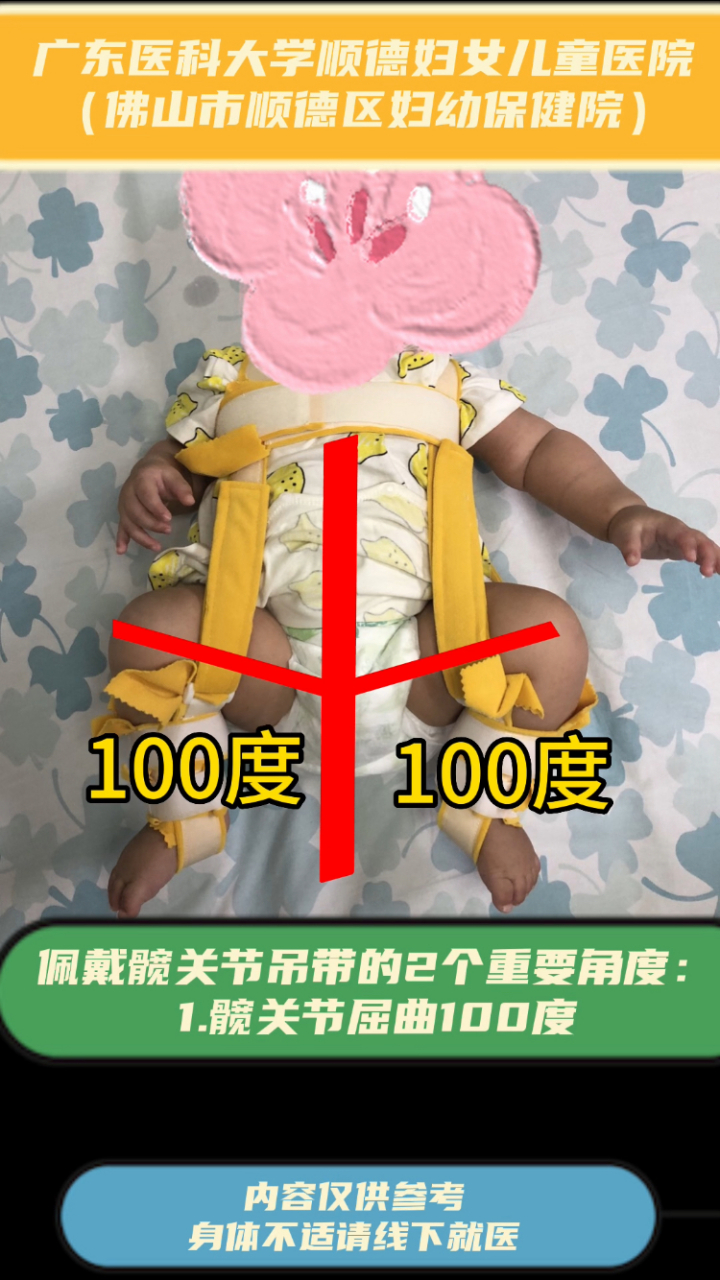 佩戴髋关节pavilk吊带的2个重要角度: 1.髋关节屈曲100度. 2.