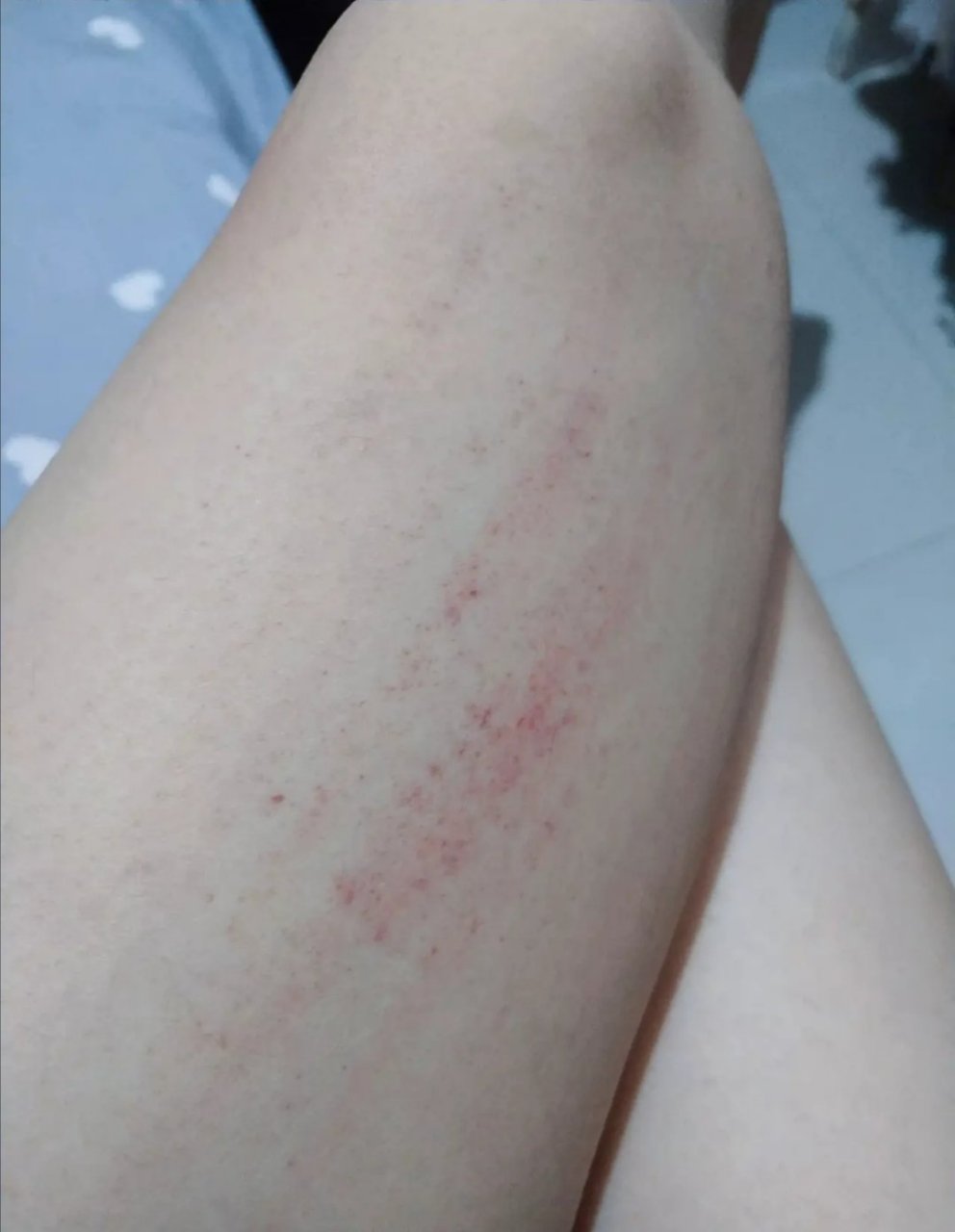 全身皮肤轻轻抓一下就呈现这一条条红印子,是热毒?还是什么?