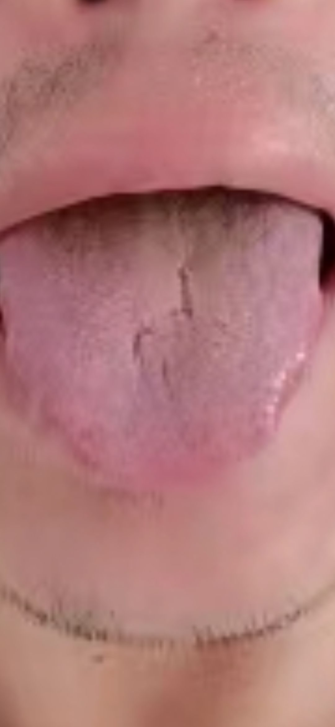 跟我学舌苔辨识#  阴虚体质,肝肾阴虚,郁久化热耗伤阴液,痰湿阻滞