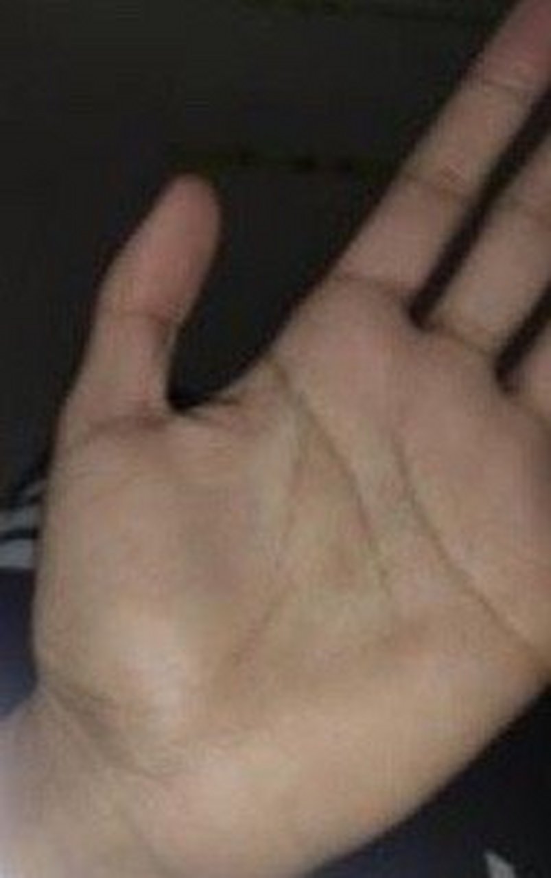 [cp]手相分析:  手指细长手掌瘦削生命线折断寓意先天体质较弱,同时