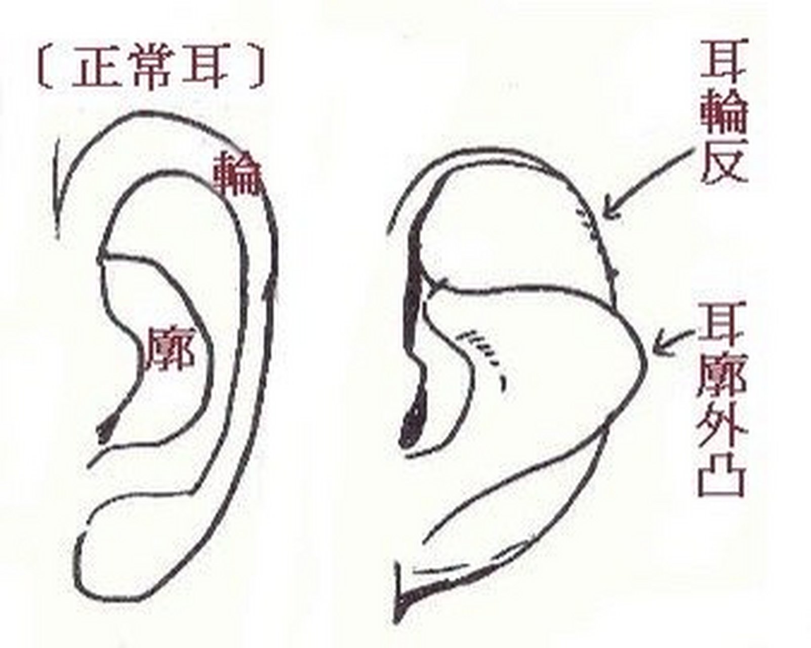 反廓耳图片