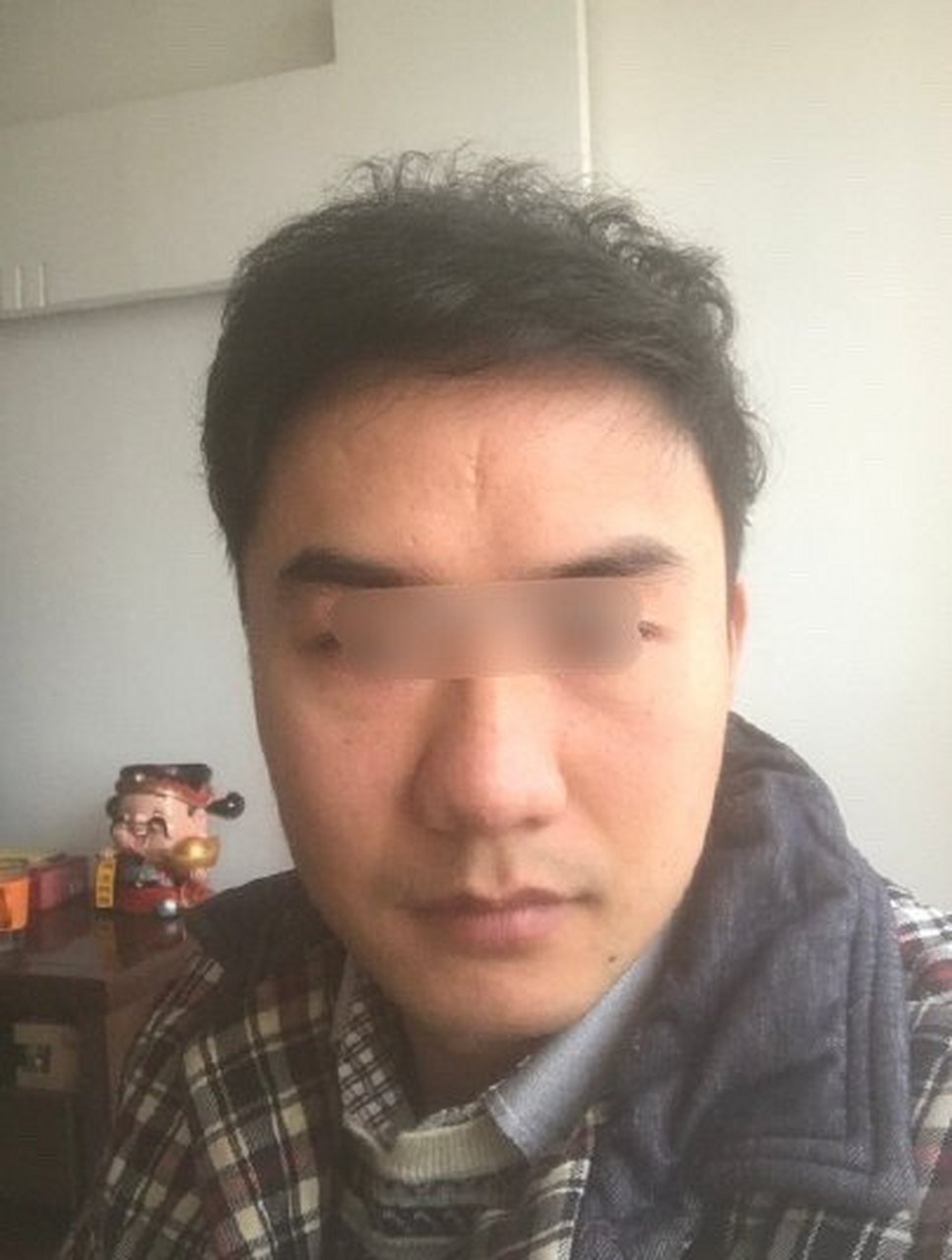 面相分析:  从面相中看,官禄宫有疤痕,印堂凹陷,这是相学中的大忌.