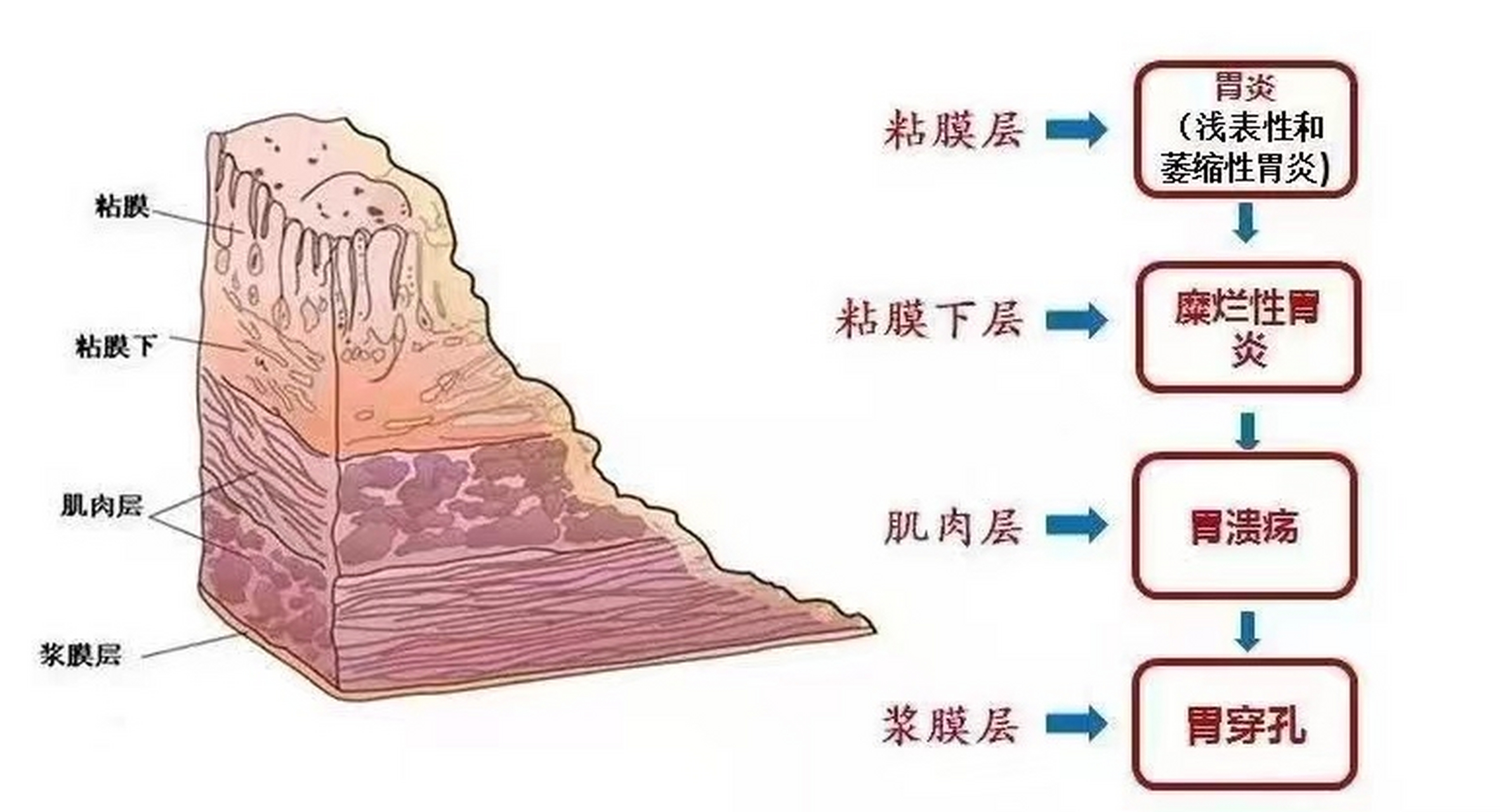 胃溃疡底部四层结构图图片