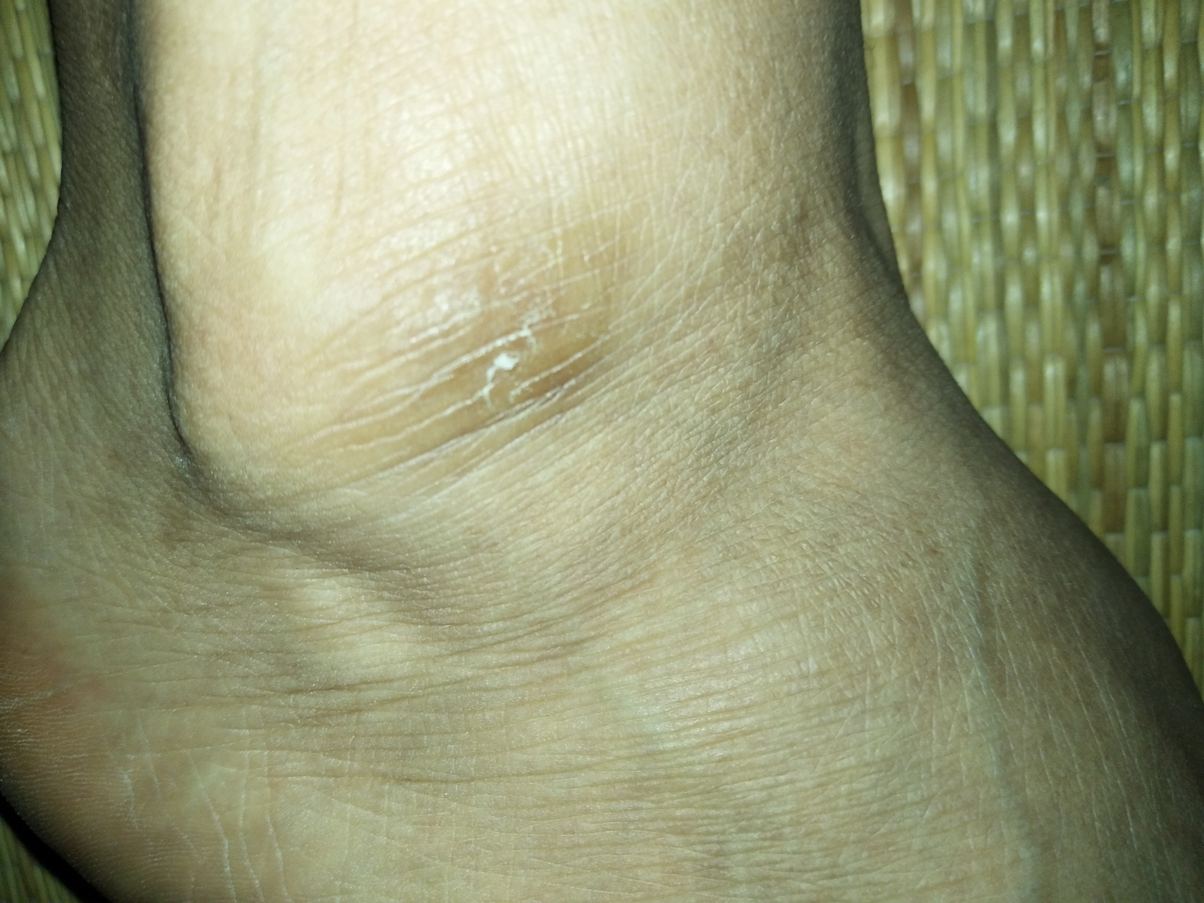 脚踝处皮肤变光滑,像癣痂不痛不痒,有谁知道这是什么吗?