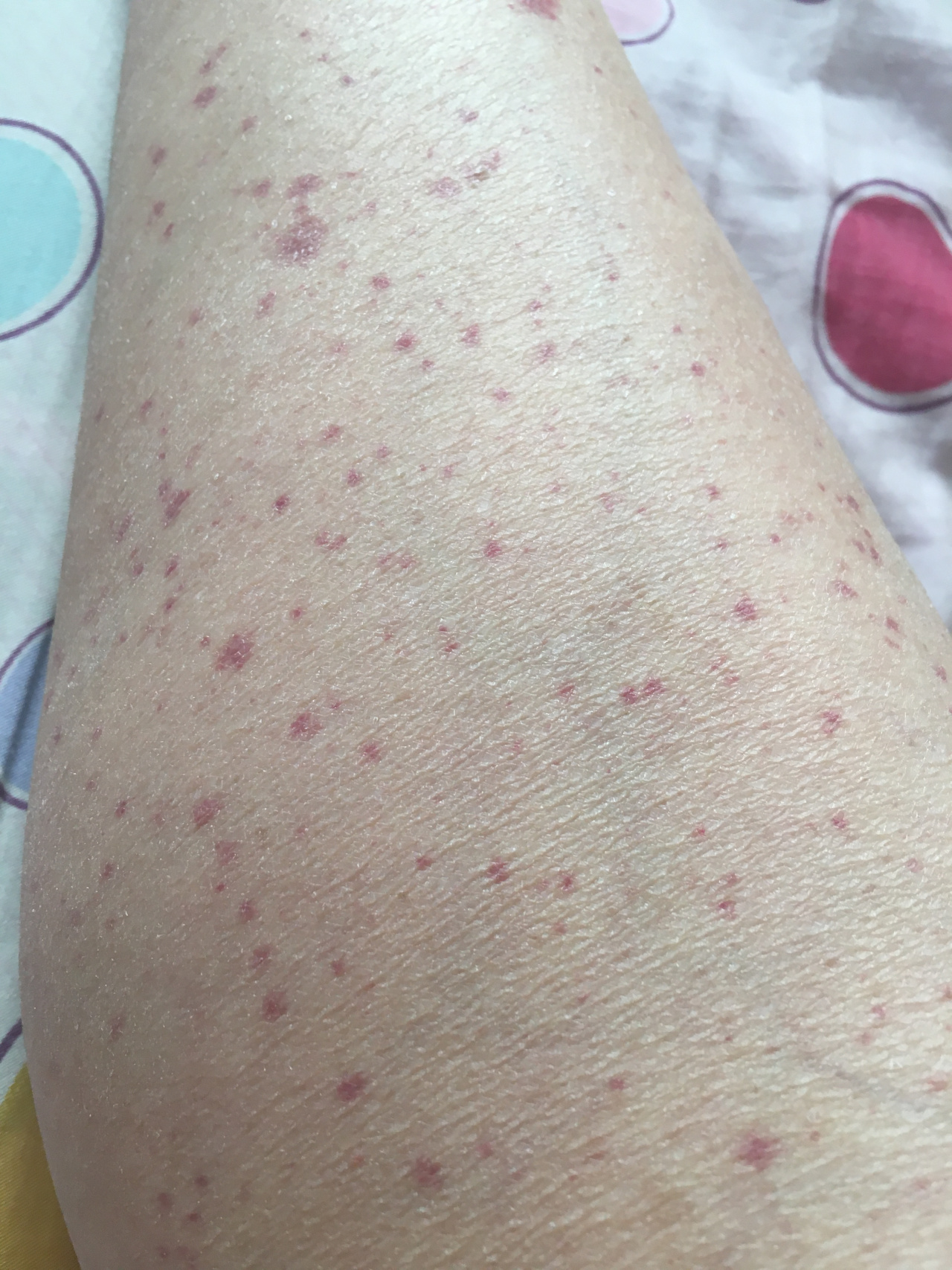 请那位好心人告诉我,这条腿上长的什么红点,还是什么紫癜吗?