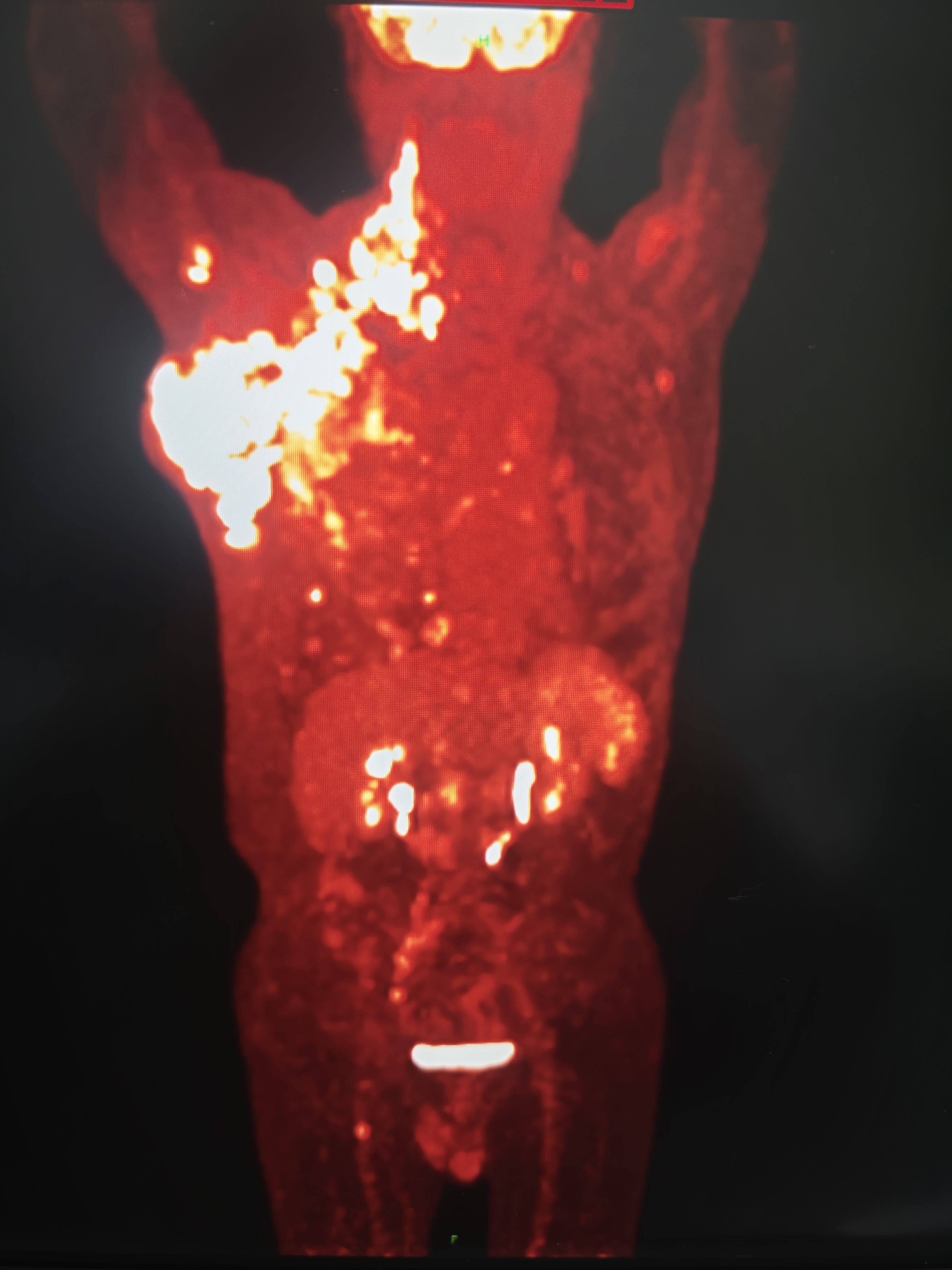 我院刚做的一例pet/ct患者,图中左上"亮区"是肿瘤,该患者确诊淋巴瘤来