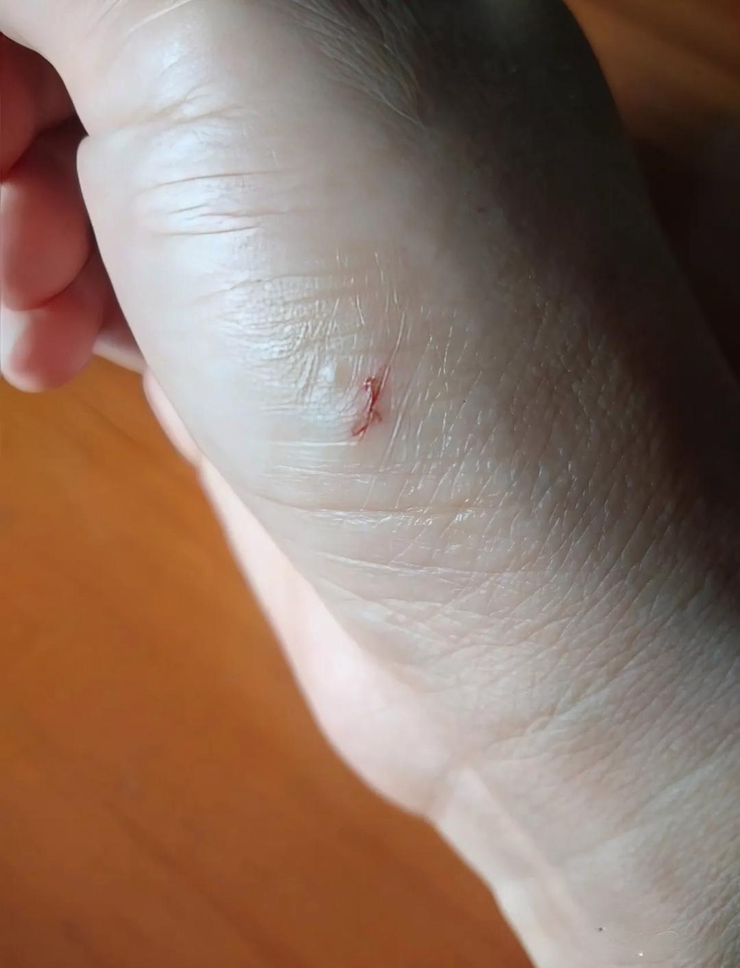 今天点子有点背,老鼠没捉到,反倒被老鼠咬了一口,怎么办呀,要打针吗