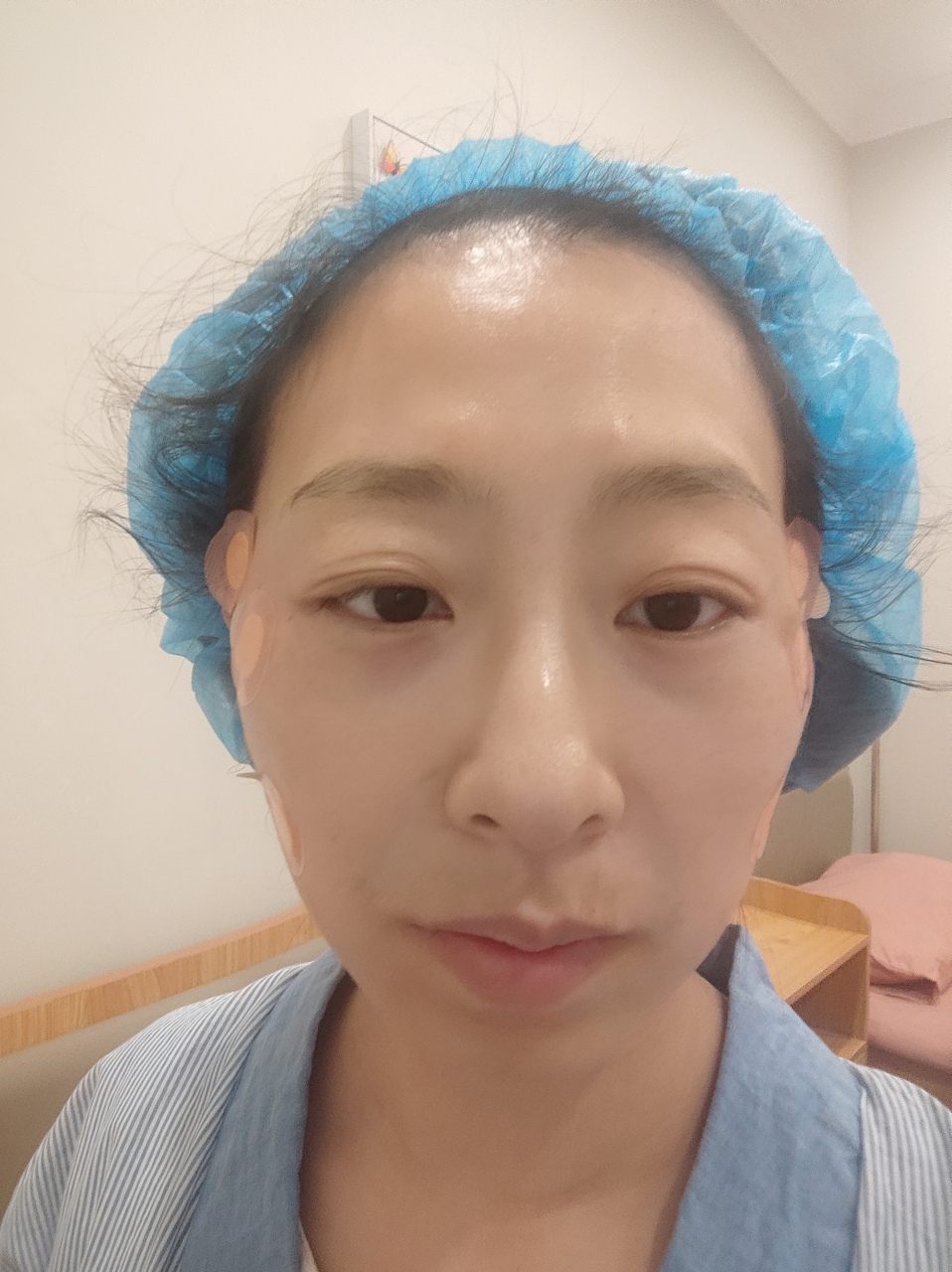 今天做了线雕手术之后的第一天,感觉不是很痛了,但是确实是有点肿