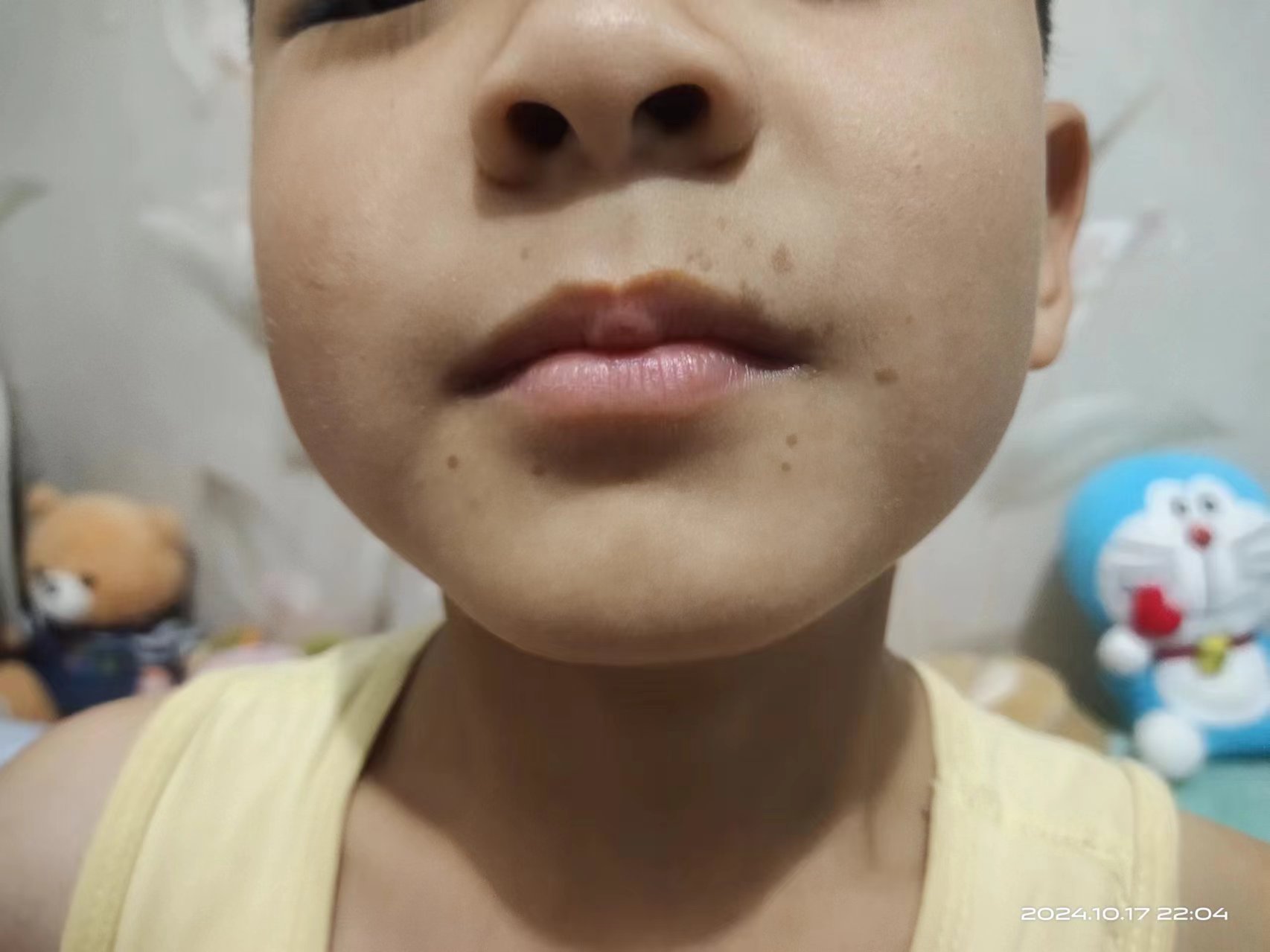 孩子最近嘴周边起了好多黑点,之前没几个现在在越来越多了,大家有知道