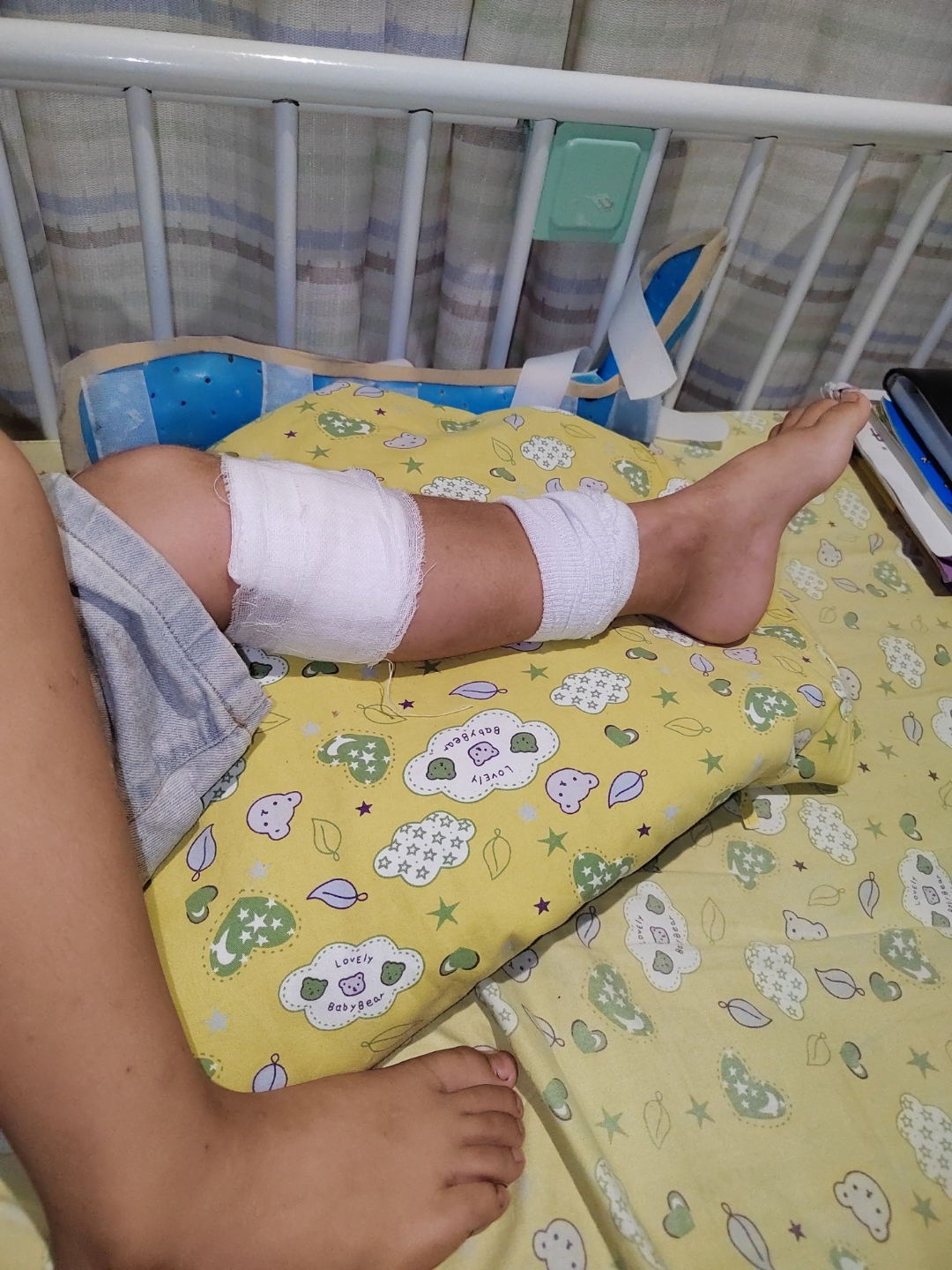 髓内钉针孔感染住院的第三天,高烧下来了,针孔边缘也有所好转