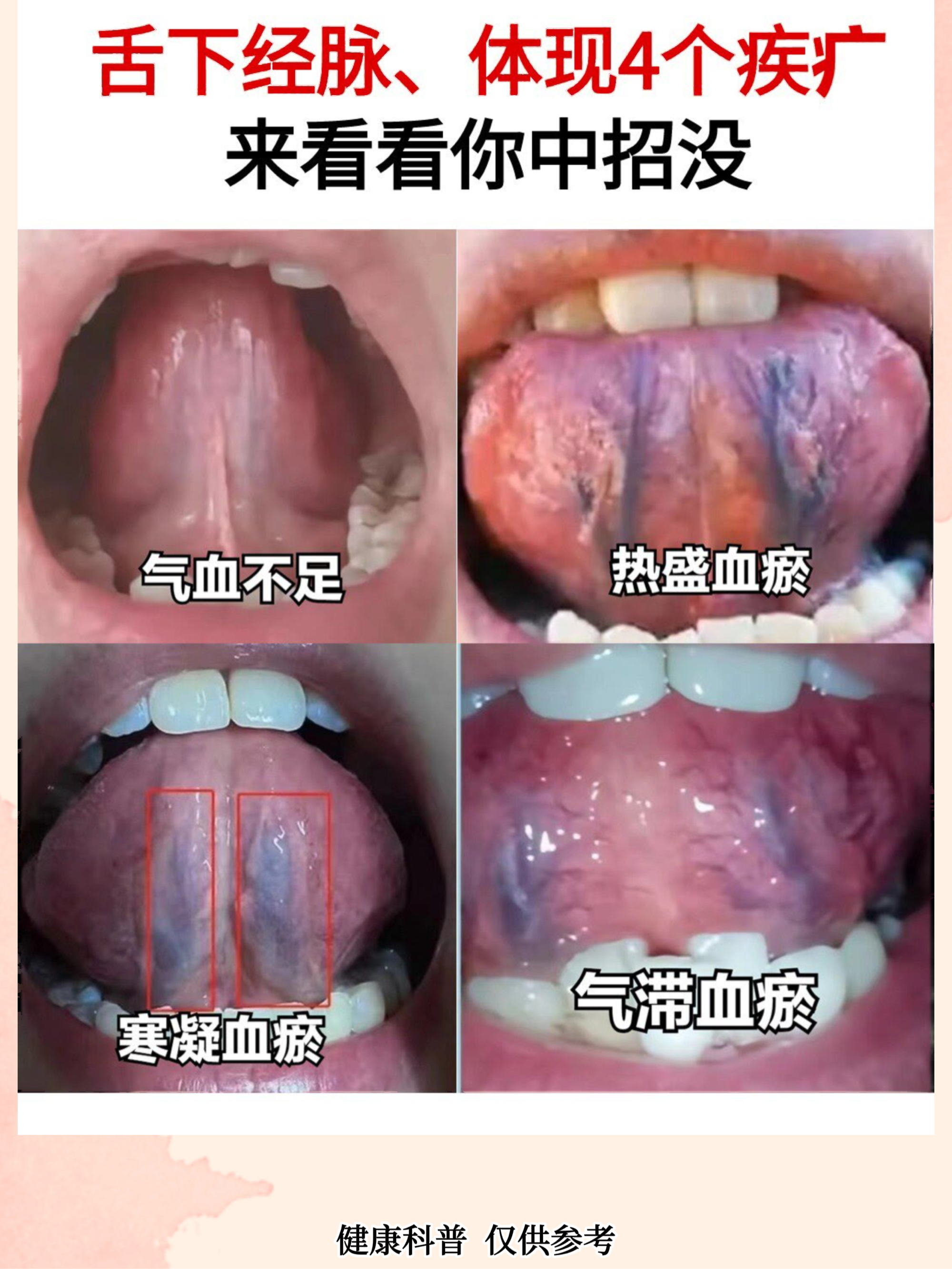 血瘀舌头图片比对图片