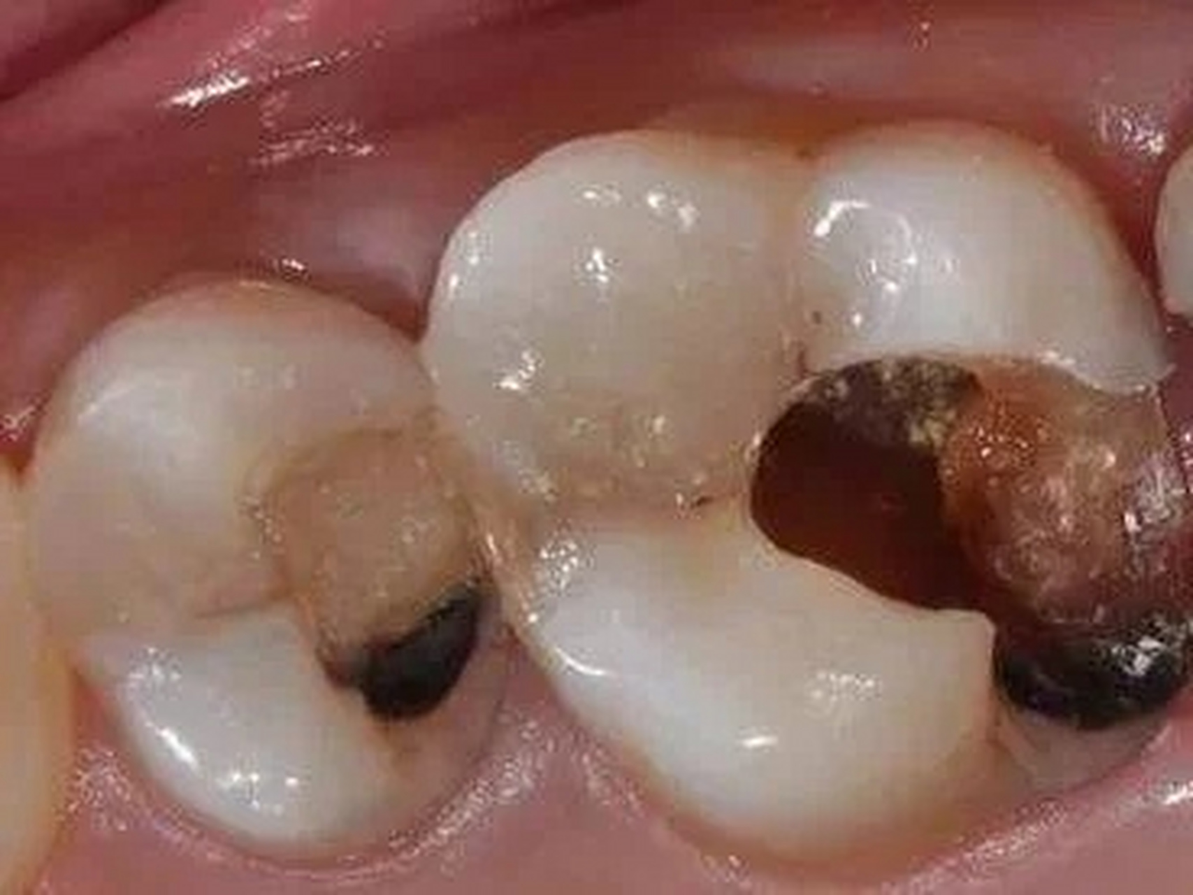 首先,如果你的牙齿上存在小黑点,这个时候一般不是很严重,肉眼也是