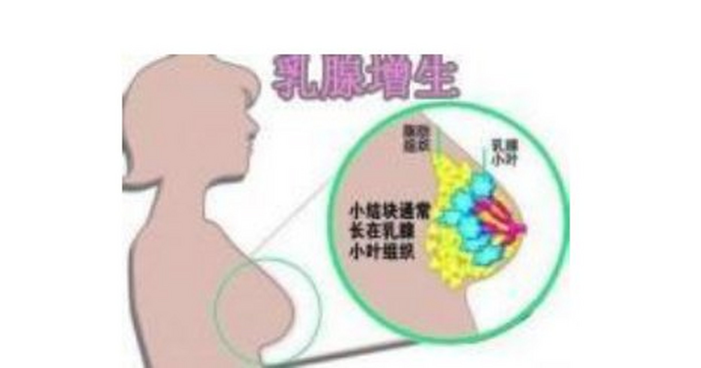 乳腺增生# #乳腺增生的症状# #乳腺增生吃什么药# #乳腺增生的治疗
