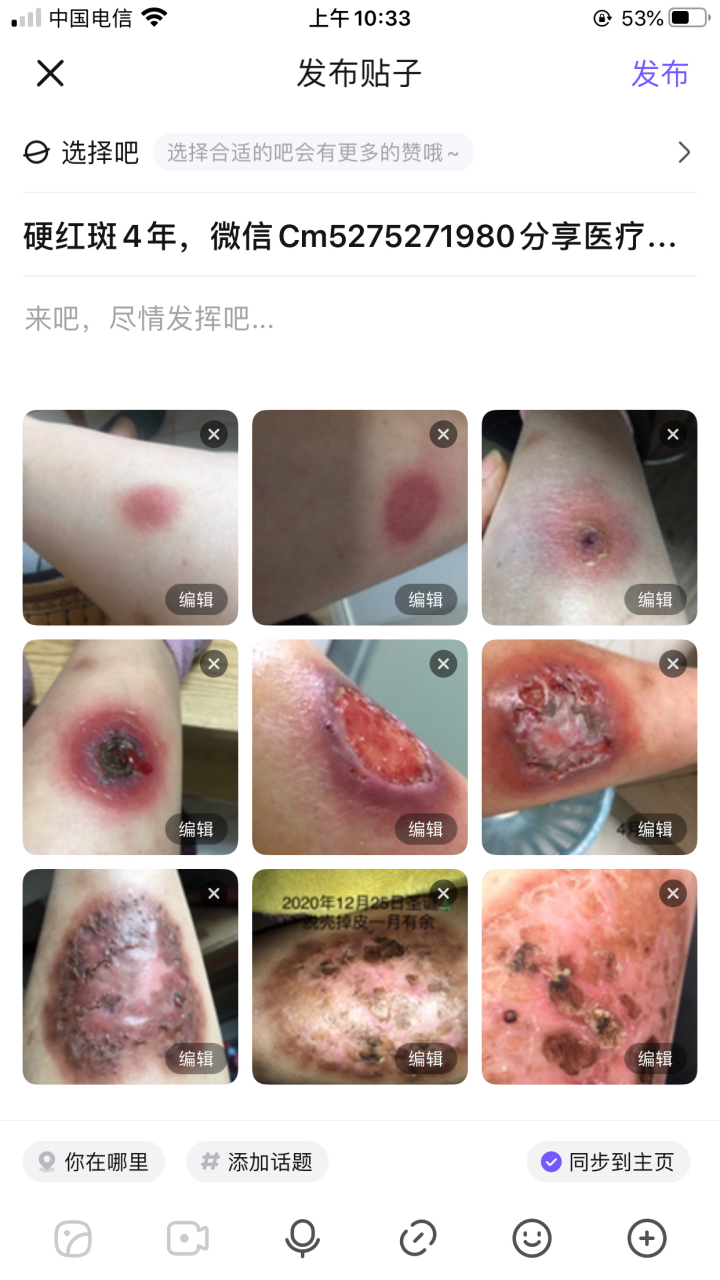 硬红斑