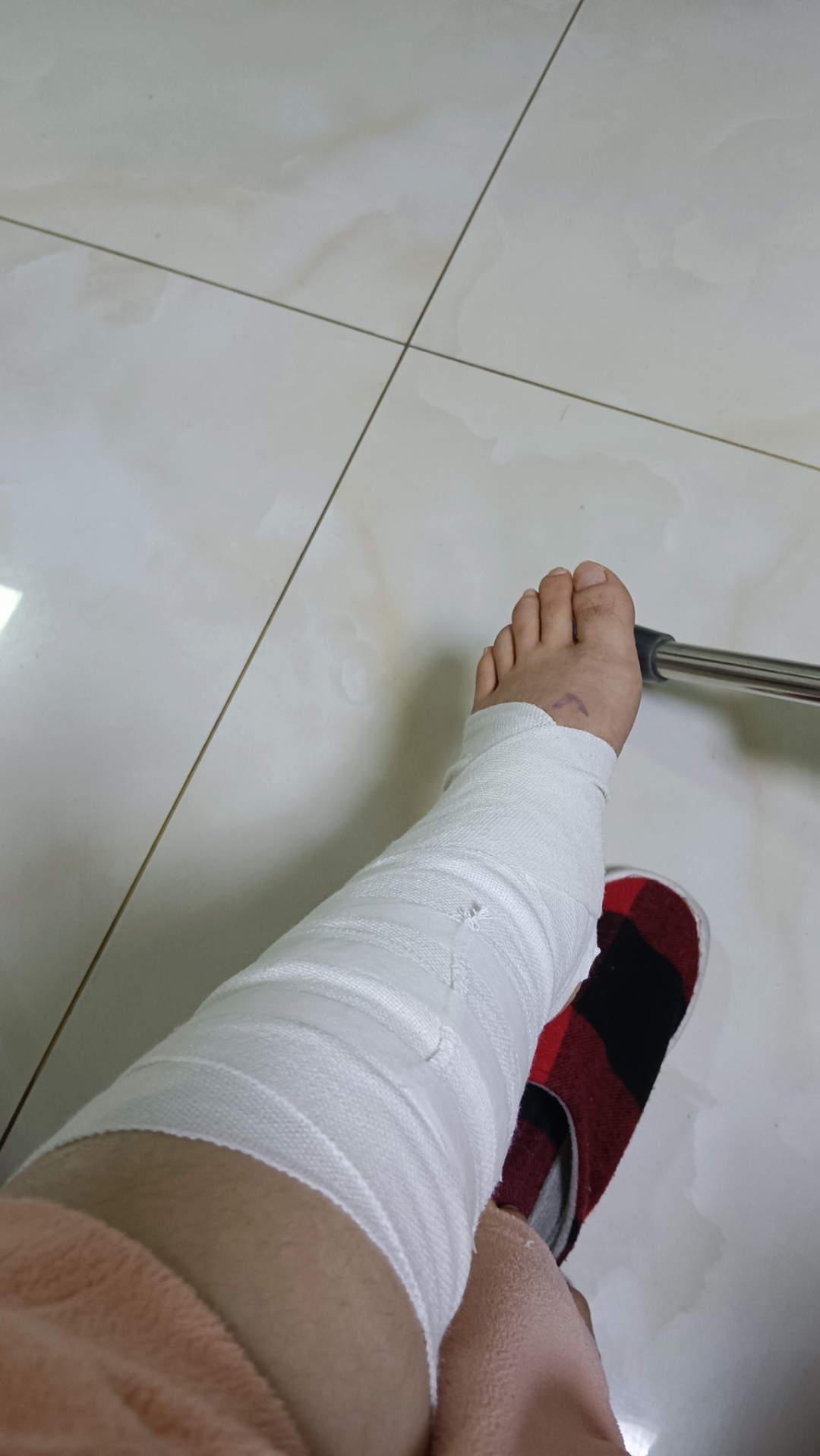 内外裸骨折16个月,两块钢板十几个钉,己全部取出,并出院,愿往后一切