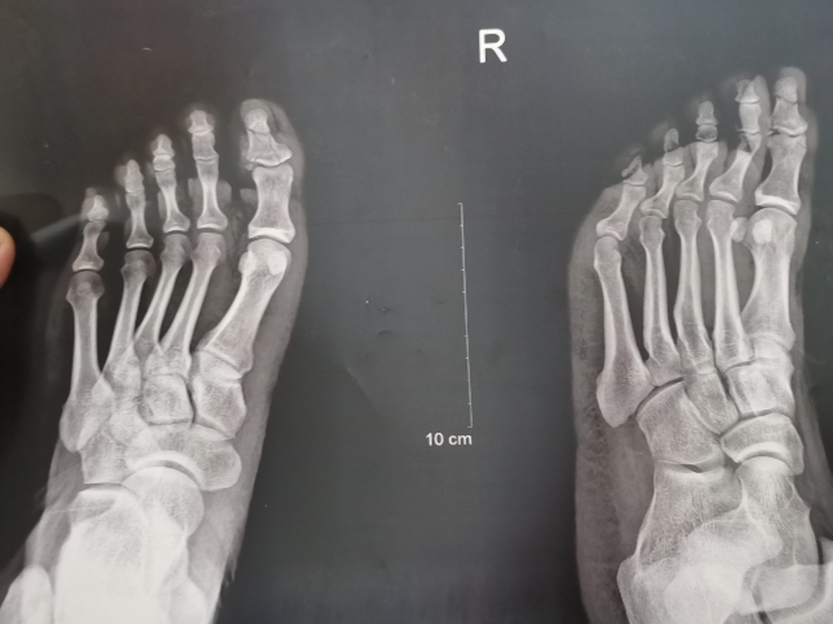 右腳大腳趾第一節骨骨折能評傷殘幾級