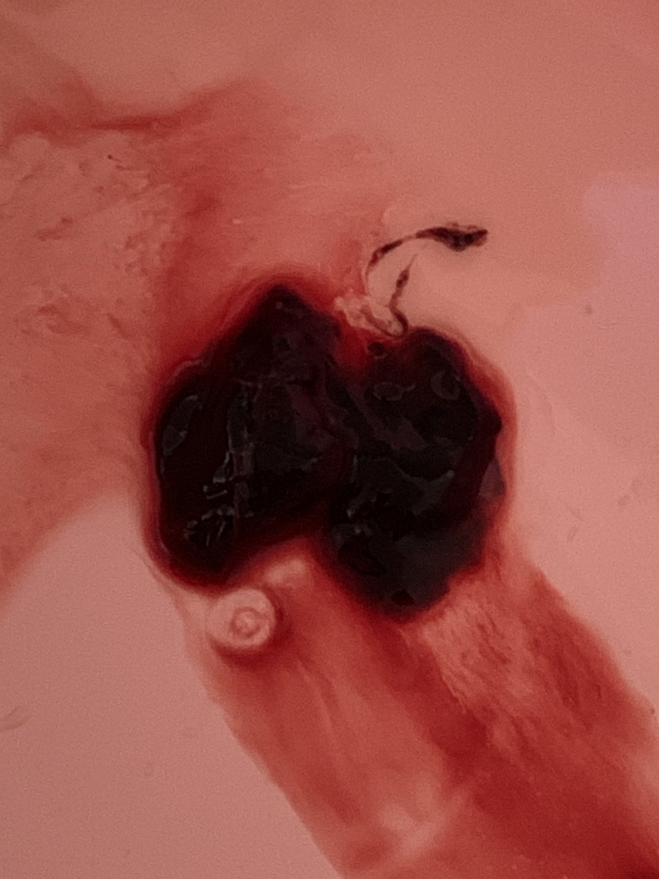 血块和内膜对比的图片图片