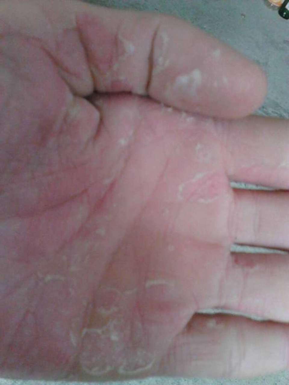小孩的手,从3岁起到现在11岁,每年夏天双手掌都脱皮严重,不痛不痒,掉