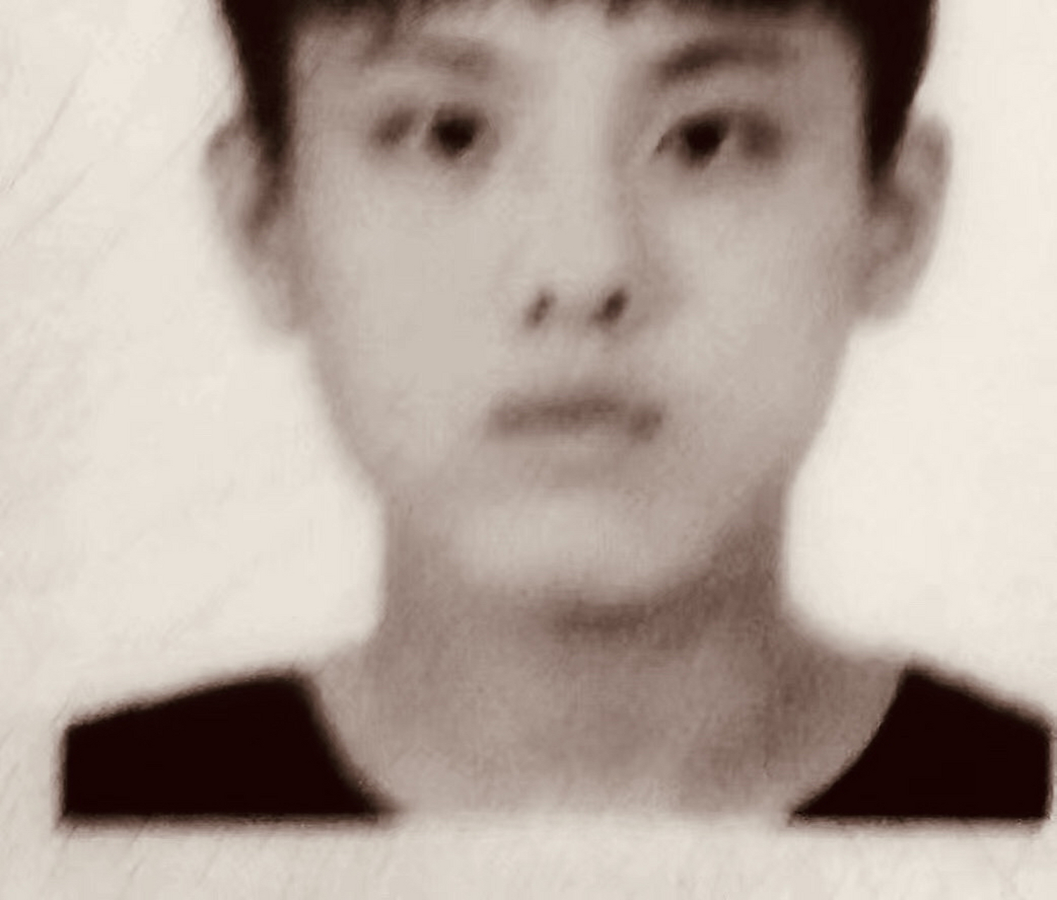 猫叫综合症患者的生长发育缓慢,同时也存在