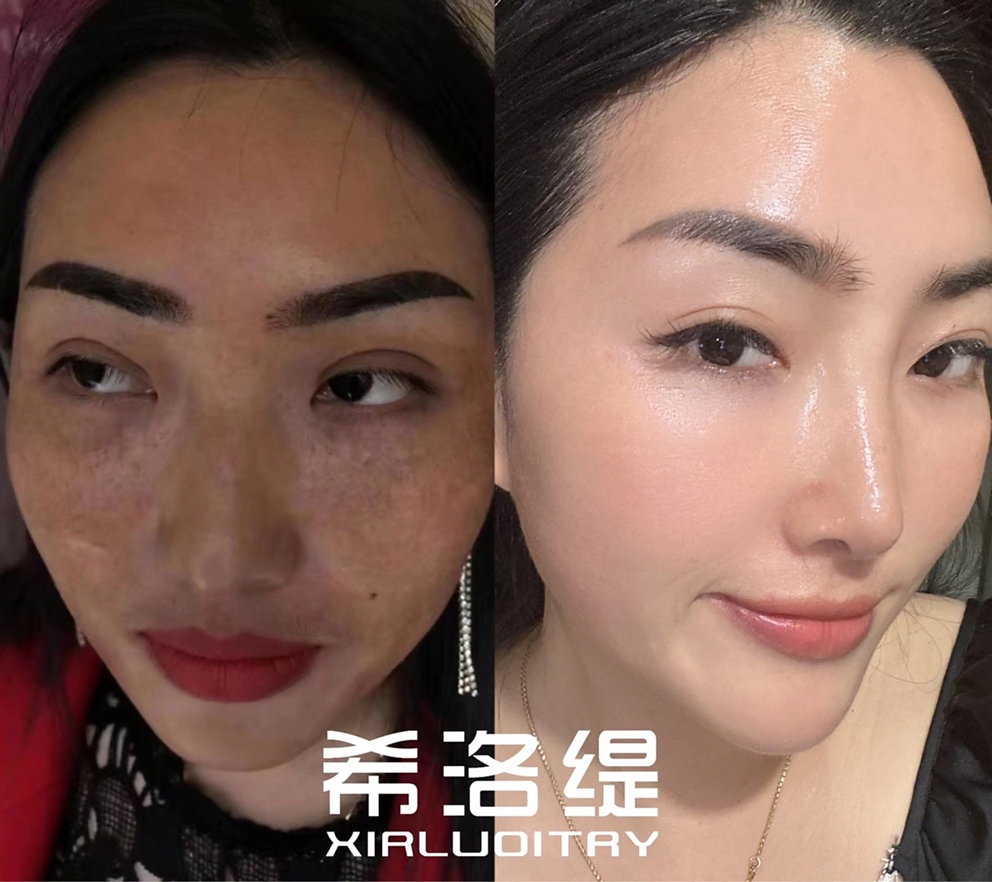 98希洛缇瓷洛69一站式医学调肤9667600566 ①毛61粗