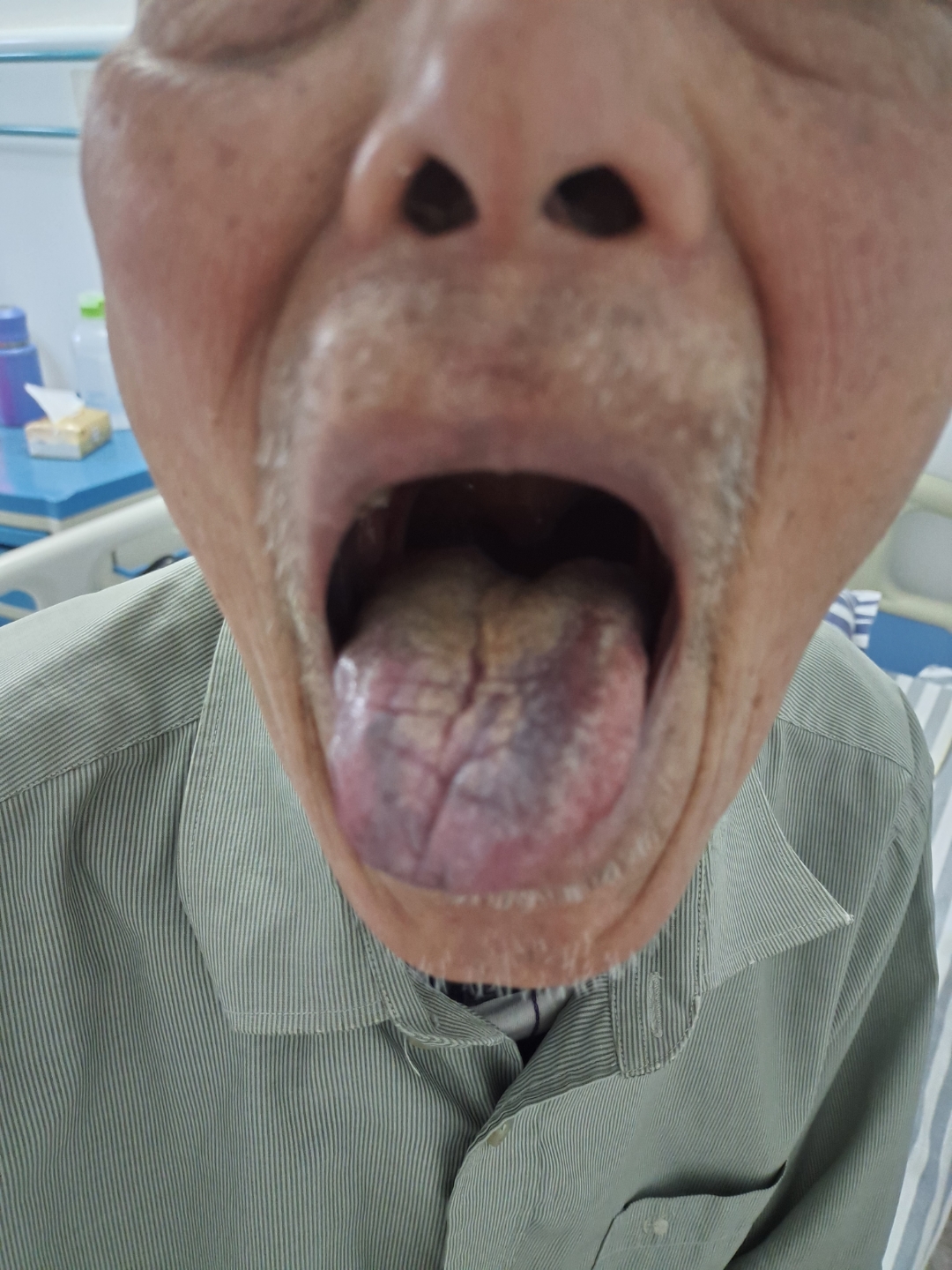患者舌苔有带紫色半有裂痕无口味不想吃饭,请问有什么办法