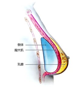 隆胸必看的的三个避坑指南  一,想做丰胸的女士,最好别做胶原蛋白