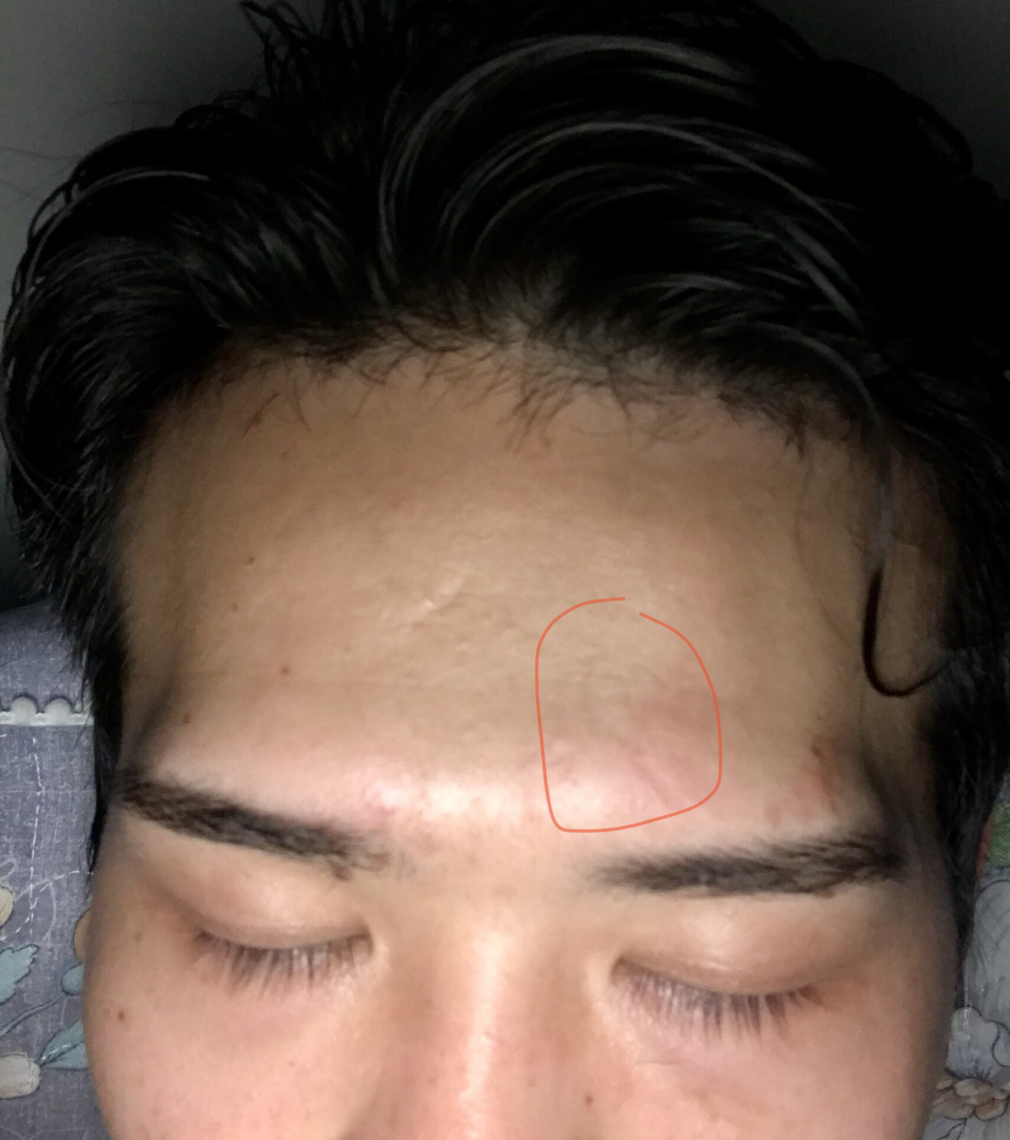 有没有大佬知道额头突然出现条纹状凹陷是什么原因导致的,没有外伤