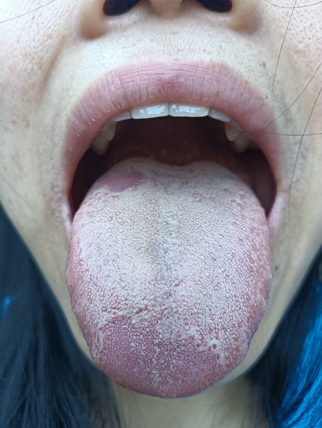 舌根溃疡也快要好了!加油!#中医自学交流
