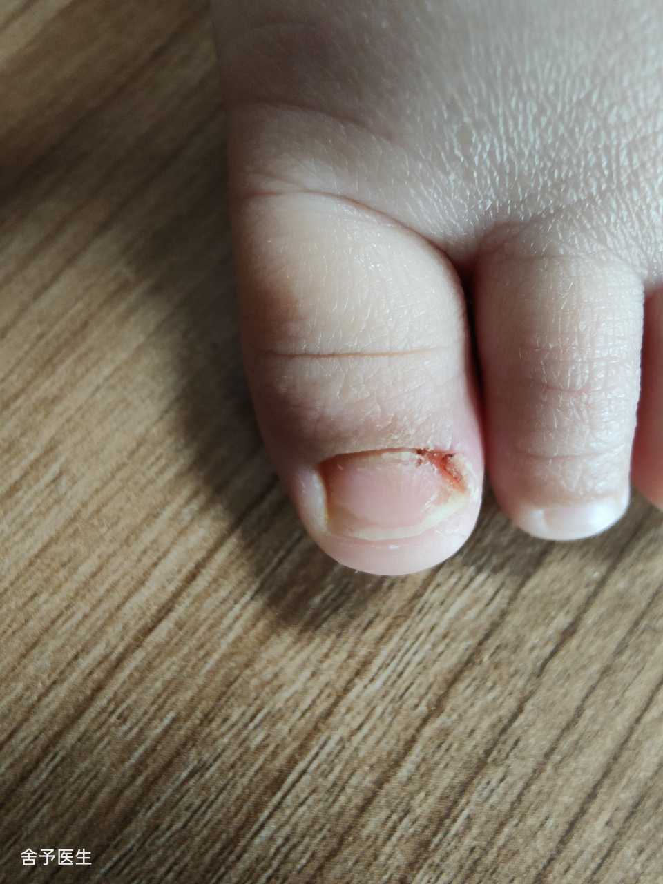 你知道小宝宝为啥会发生甲沟炎吗